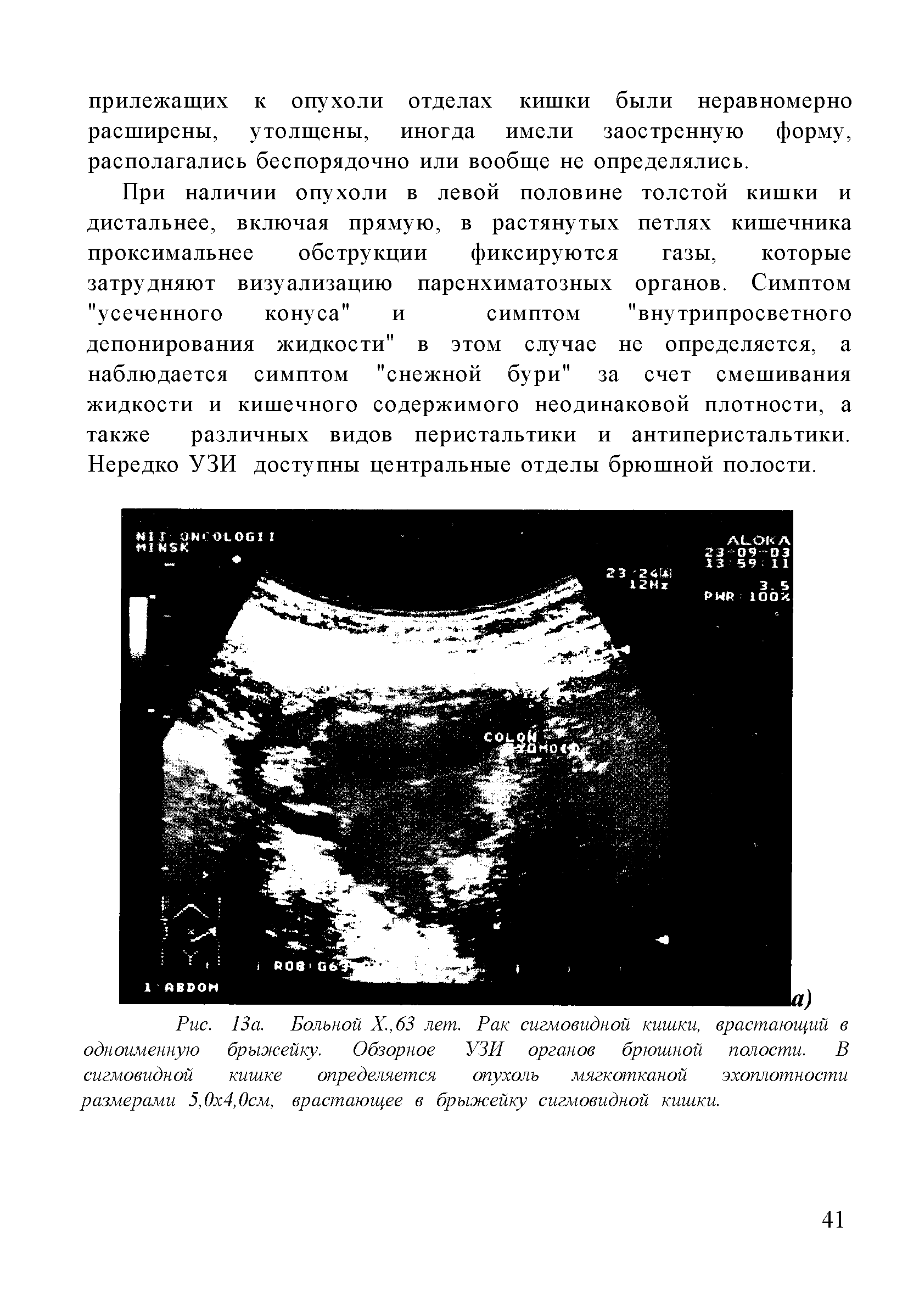 Рис. 13а. Больной Х.,63 лет. Рак сигмовидной кишки, врастающий в одноименную брыжейку. Обзорное УЗИ органов брюшной полости. В сигмовидной кишке определяется опухоль мягкотканой эхоплотности размерами 5,0 4, Осм, врастающее в брыжейку сигмовидной кишки.