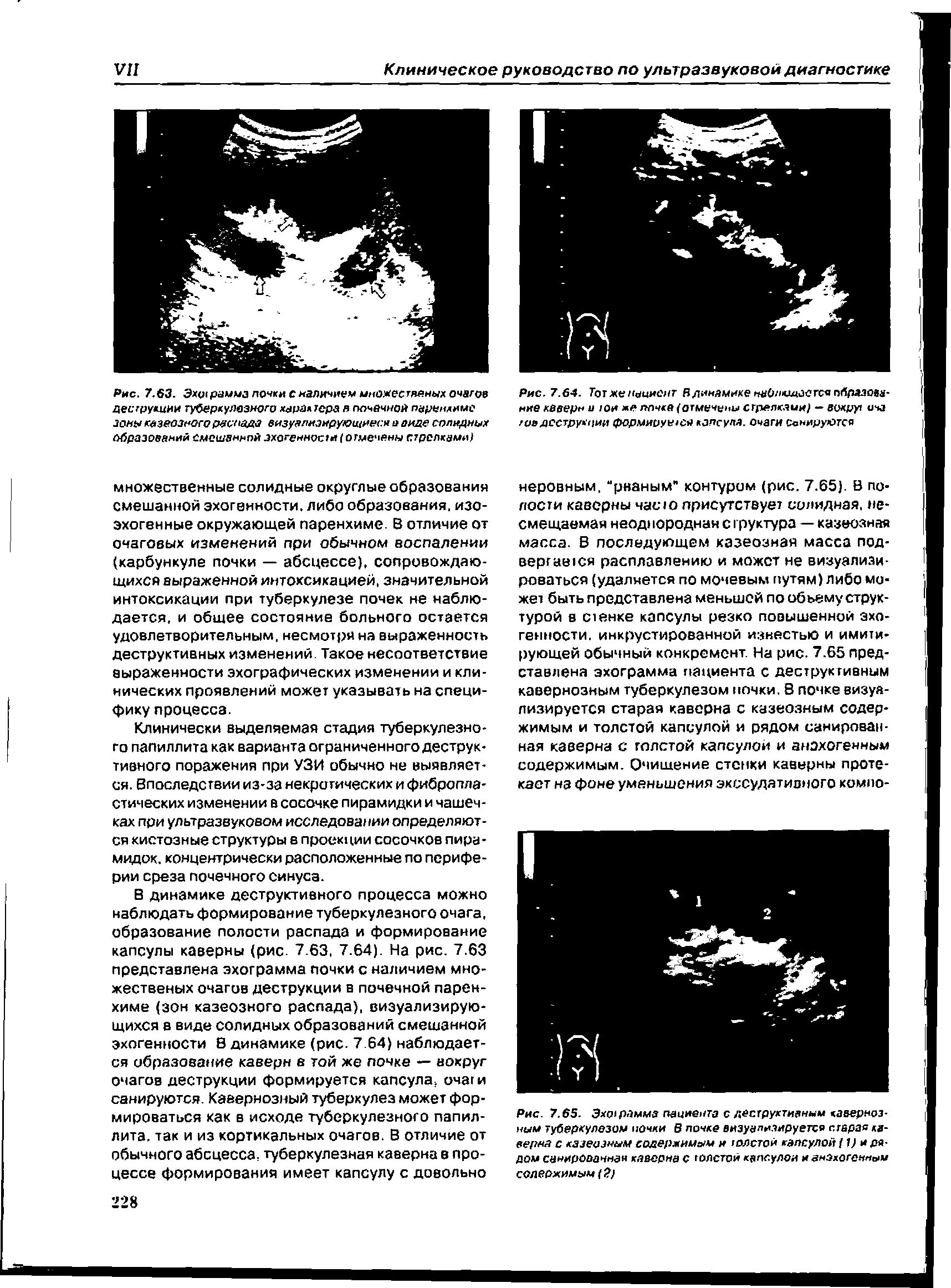 Рис. 7.65. Эхотрамма пациента с деструктивным кавернозным туберкулезом почки В почке визуализируется старая каверна с казеозным содержимым и толстой капсулой (1) и рядом санирооаннз каверна с толстой капс.улои и енахогенным содержимым (2)...