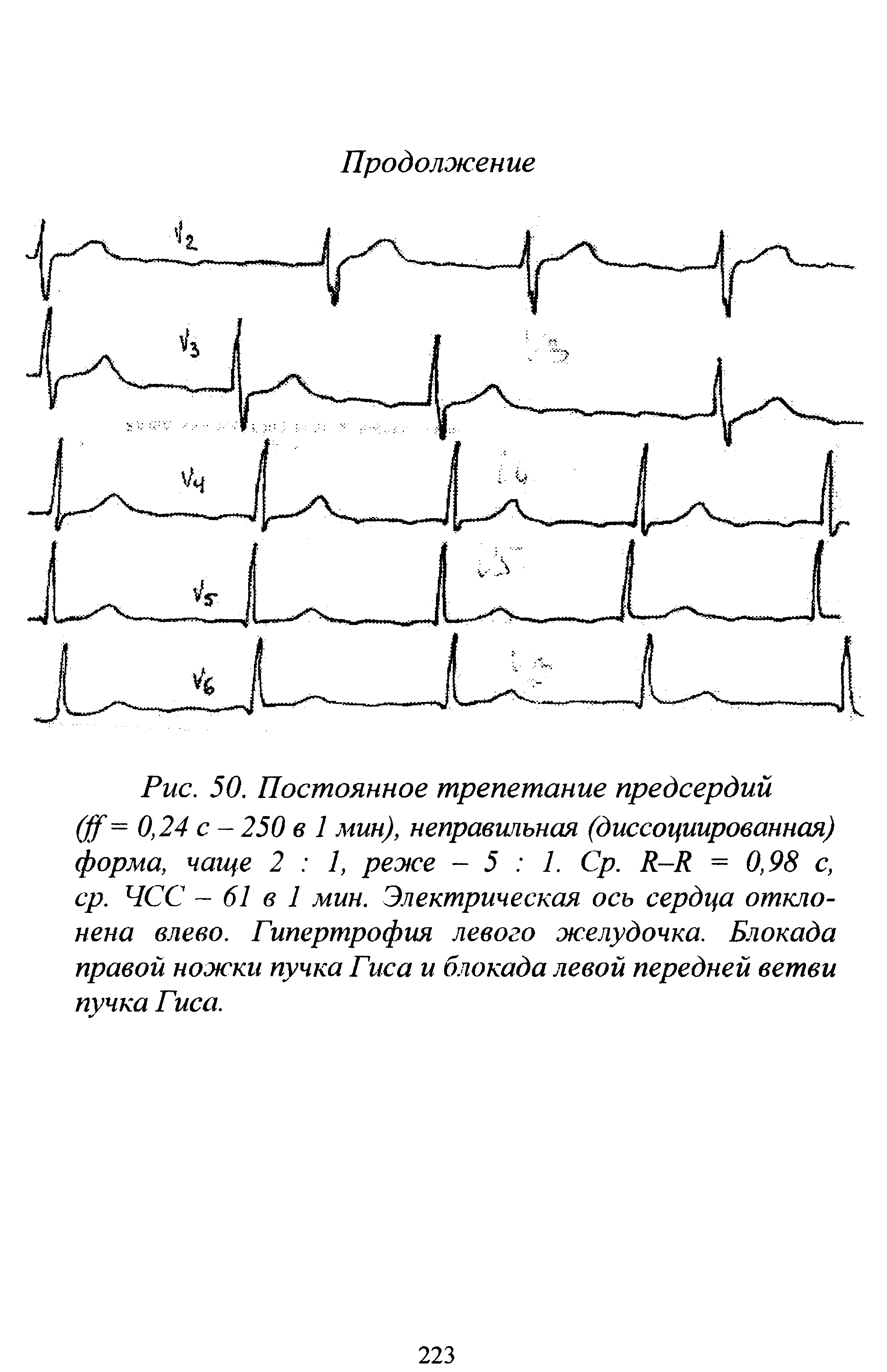 Рис. 50. Постоянное трепетание предсердий (фф = 0,24 с - 250 в 1 мин), неправильная (диссоциированная) форма, чаще 2 1, реже -5 1. Ср. Б-Б = 0,98 с, ср. ЧСС - 61 в 1 мин. Электрическая ось сердца отклонена влево. Гипертрофия левого желудочка. Блокада правой ножки пучка Гиса и блокада левой передней ветви пучка Гиса.