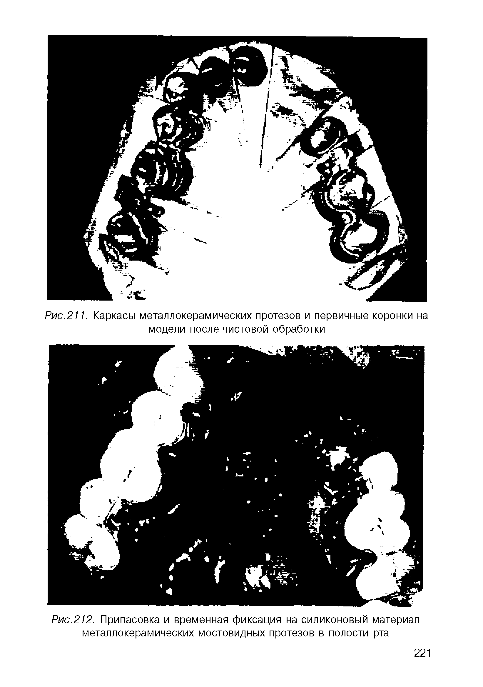 Рис.212. Припасовка и временная фиксация на силиконовый материал металлокерамических мостовидных протезов в полости рта...