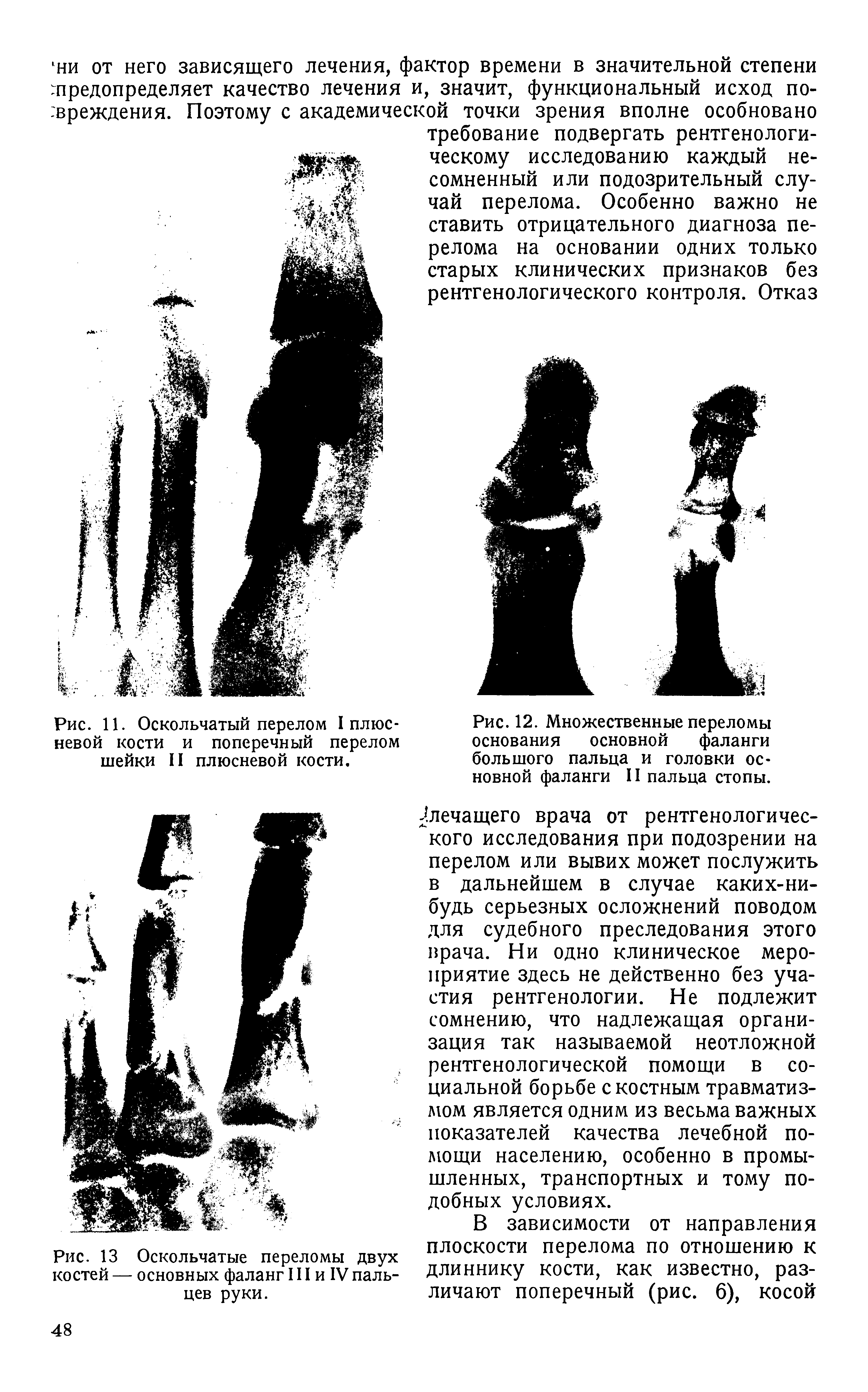 Рис. 11. Оскольчатый перелом плюсневой кости и поперечный перелом шейки II плюсневой кости.