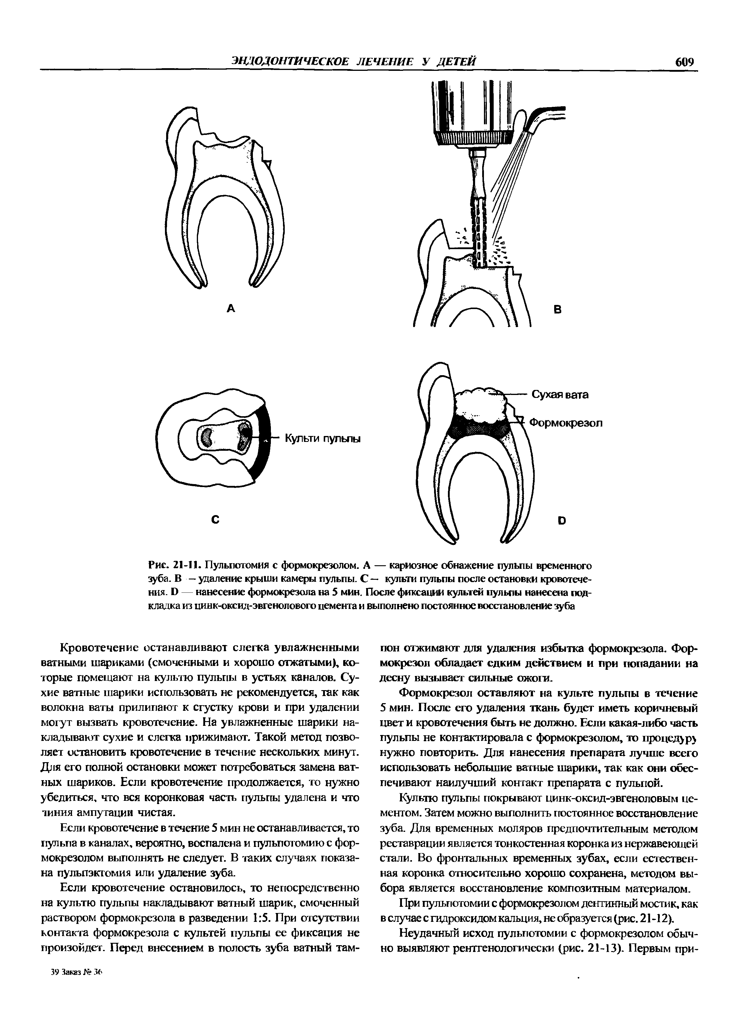 Рис. 21-11. Пульпотомия с формокрезолом. А — кариозное обнажение пульпы временного зуба. В — удаление крыши камеры пульпы. С — культи пульпы после остановки кровотечения. Б — нанесение формокрезола на 5 мин. После фиксации культей пульпы нанесена подкладка из цинк-оксид-эвгенолового цемента и выполнено постоянное восстановление зуба...