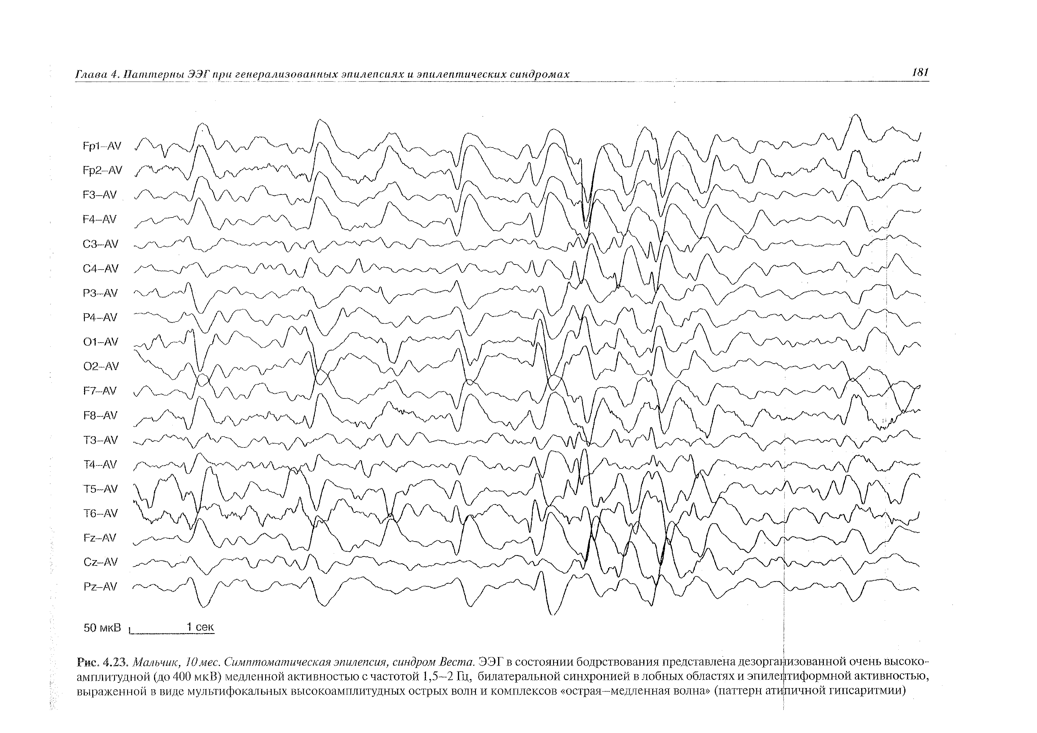 Рис. 4.23. Мальчик, Юмес. Симптоматическая эпилепсия, синдром Веста. ЭЭГ в состоянии бодрствования представлена дезорганизованной очень высокоамплитудной (до 400 мкВ) медленной активностью с частотой 1,5—2 Гц, билатеральной синхронией в лобных областях и эпилептиформной активностью,...