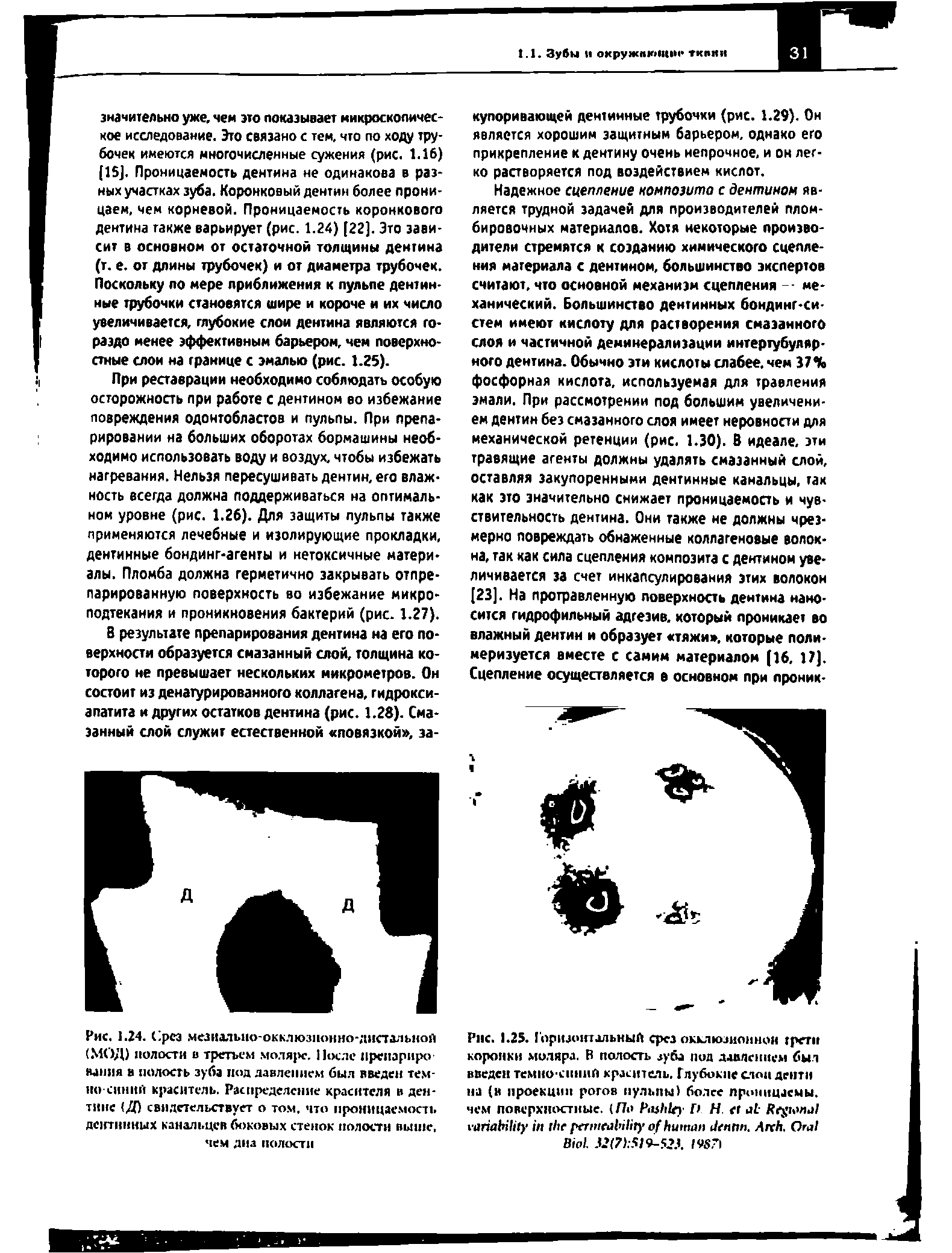 Рис. 1.24. С1рсз мезиалыю-окклюзионно-дистзлыюй (.МОД) полости в третьем моляре. После преиариро-миля в полость зуба под давлением был введен темно-синий краситель. Распределение красителя в дентине (Д) свидетельствует о том, что проницаемость дентинных канальцев боковых стенок полости выше, чем дна полости...