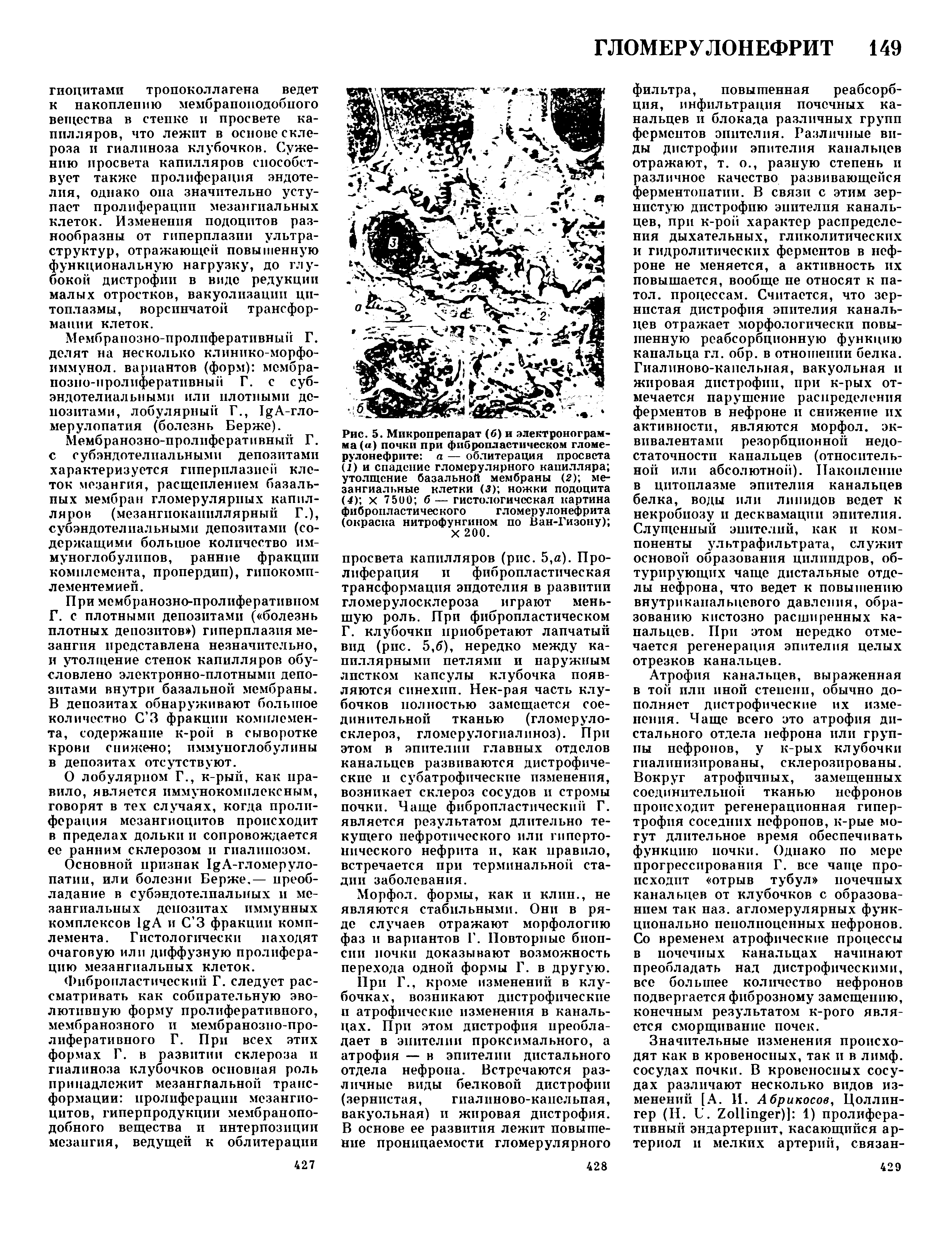 Рис. 5. Микропрепарат (б) и электронограм-ма (а) почки при фибропластическом гломерулонефрите а — облитерация просвета (2) и спадение гломерулярного капилляра утолщение базальной мембраны (2) мезангиальные клетки (3) ножки подоцита (4) х 7500 б — гистологическая картина фибропластичес кого гломерулонефрита (окраска нитрофунгином по Ван-Гизону) X 200.