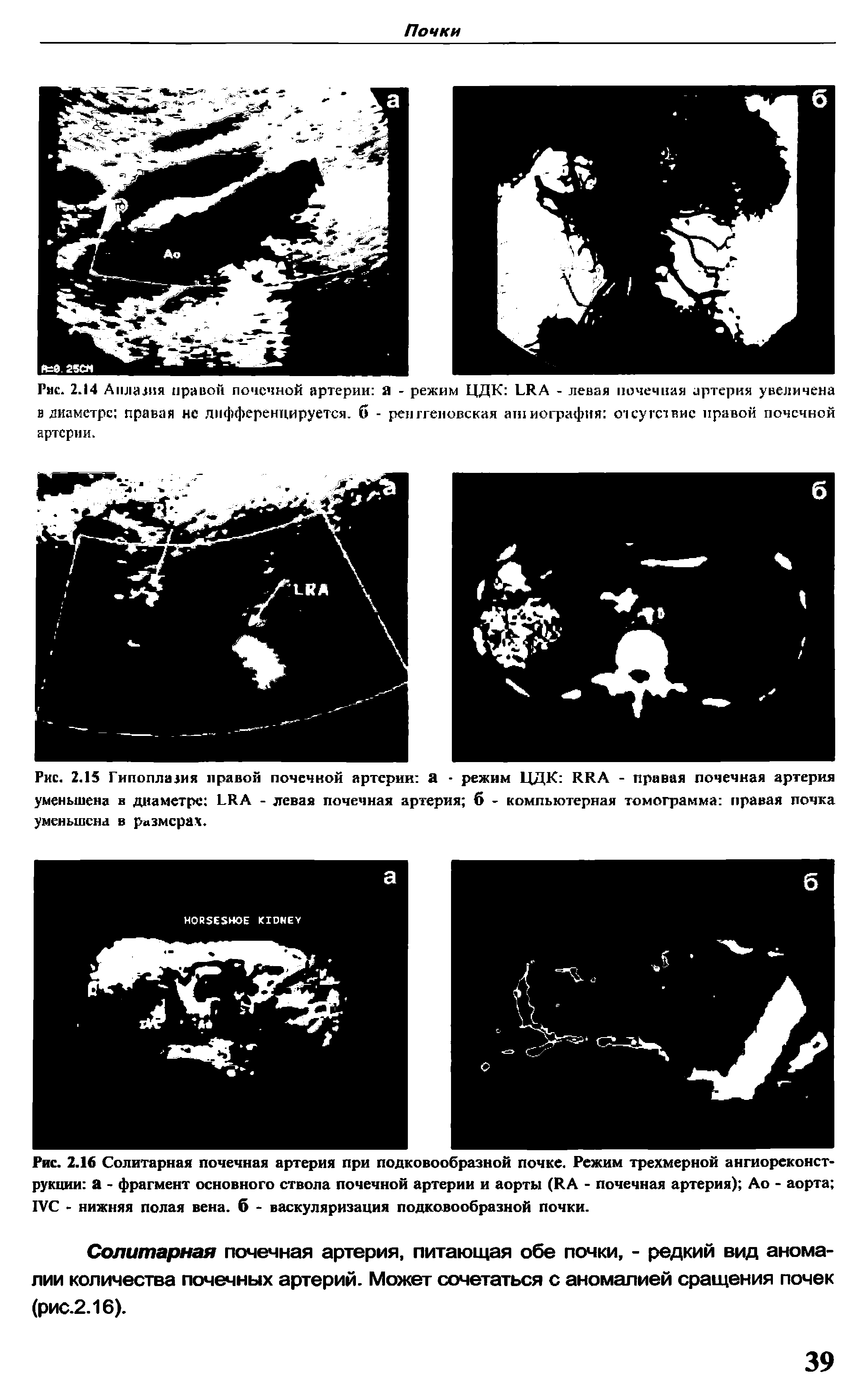 Рис. 2.15 Гипоплазия правой почечной артерии а - режим ЦДК RRA - правая почечная артерия уменьшена в диаметре LRA - левая почечная артерия б - компьютерная томограмма правая почка уменьшена в размерах.