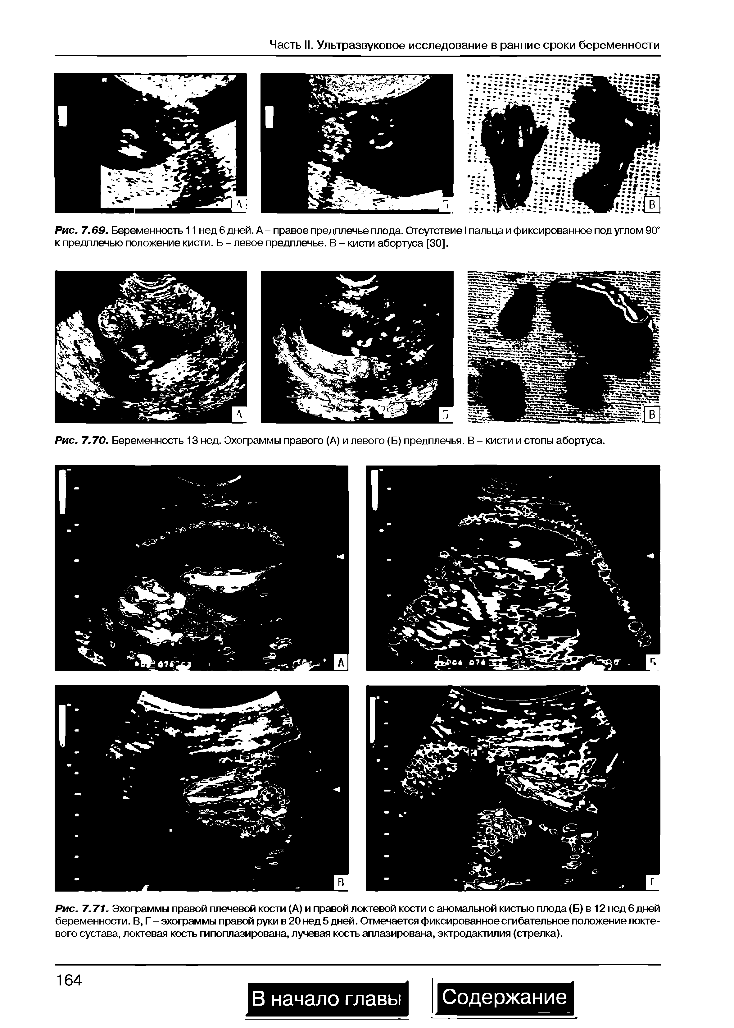 Рис. 7.70. Беременность 13 нед. Эхограммы правого (А) и левого (Б) предплечья. В - кисти и стопы абортуса.
