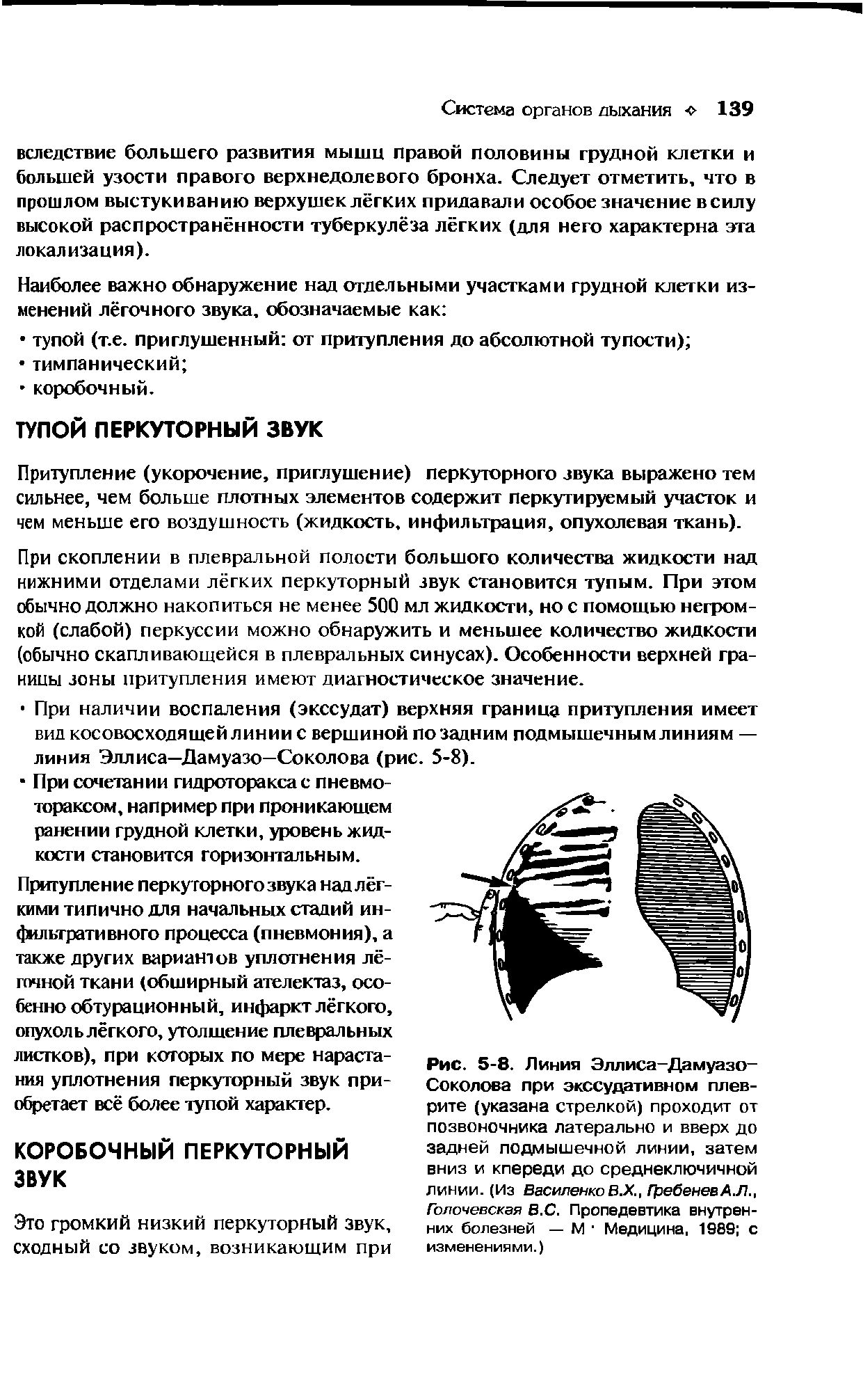 Рис. 5-8. Линия Эллиса-Дамуазо-Соколова при экссудативном плеврите (указана стрелкой) проходит от позвоночника латерально и вверх до задней подмышечной линии, затем вниз и кпереди до среднеключичной линии. (Из Василенко В.Х., ГребеневАЛ., Голочевская В.С. Пропедевтика внутренних болезней — М Медицина, 1989 с...