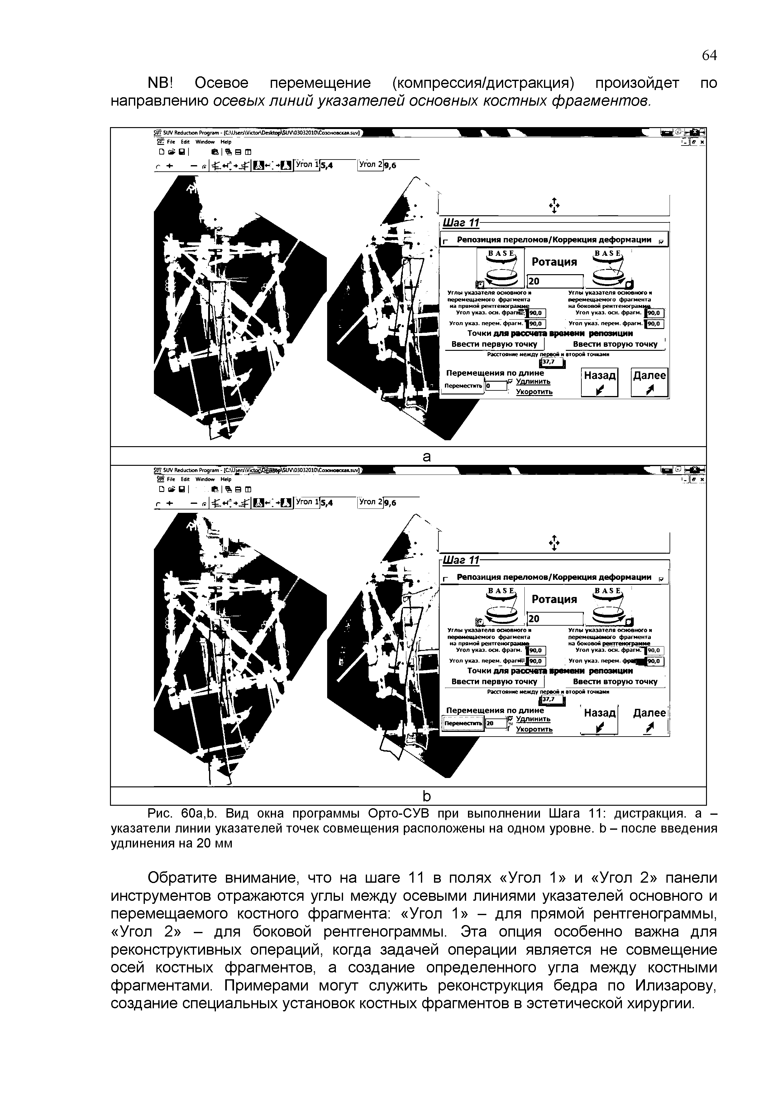 Рис. 60а,Ь. Вид окна программы Орто-СУВ при выполнении Шага 11 дистракция, а -указатели линии указателей точек совмещения расположены на одном уровне. Ь - после введения удлинения на 20 мм...