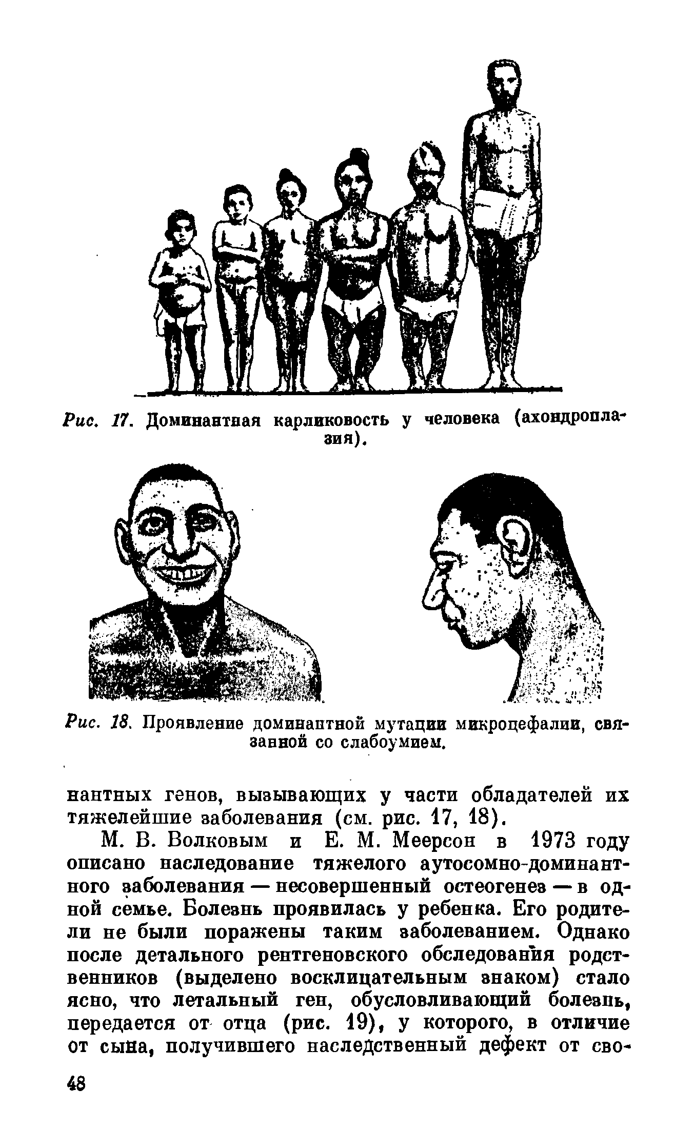 Рис. 18. Проявление доминантной мутации микроцефалии, связанной со слабоумием.