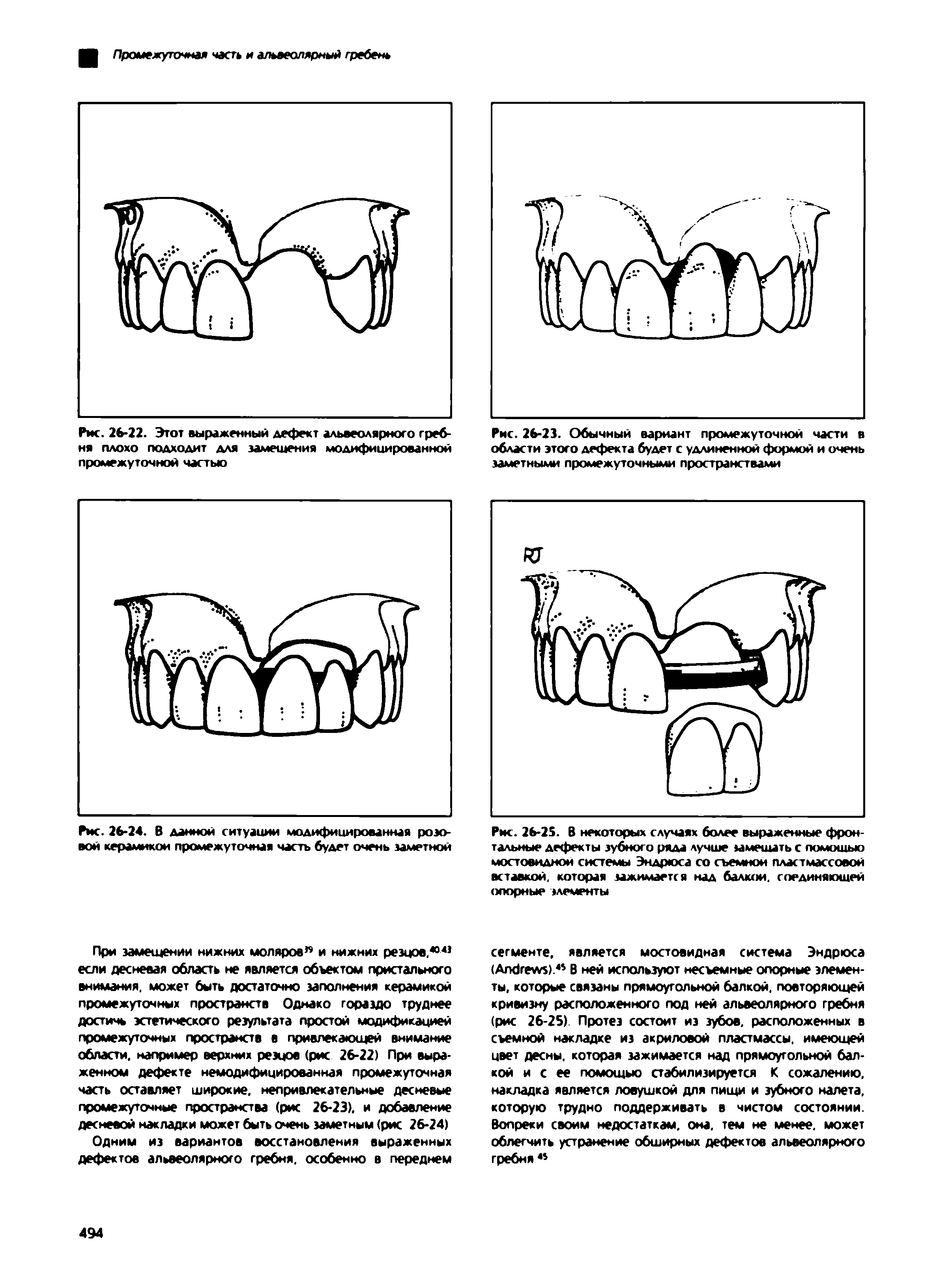 Рис. 26-25. В некоторых случаях более выраженные фронтальные дефекты зубного ряда лучше замешать с помощью мостовидной системы Эндрюса со съемной пластмассовой вставкой, которая зажимается над балкой, соединяющей опорные элементы...