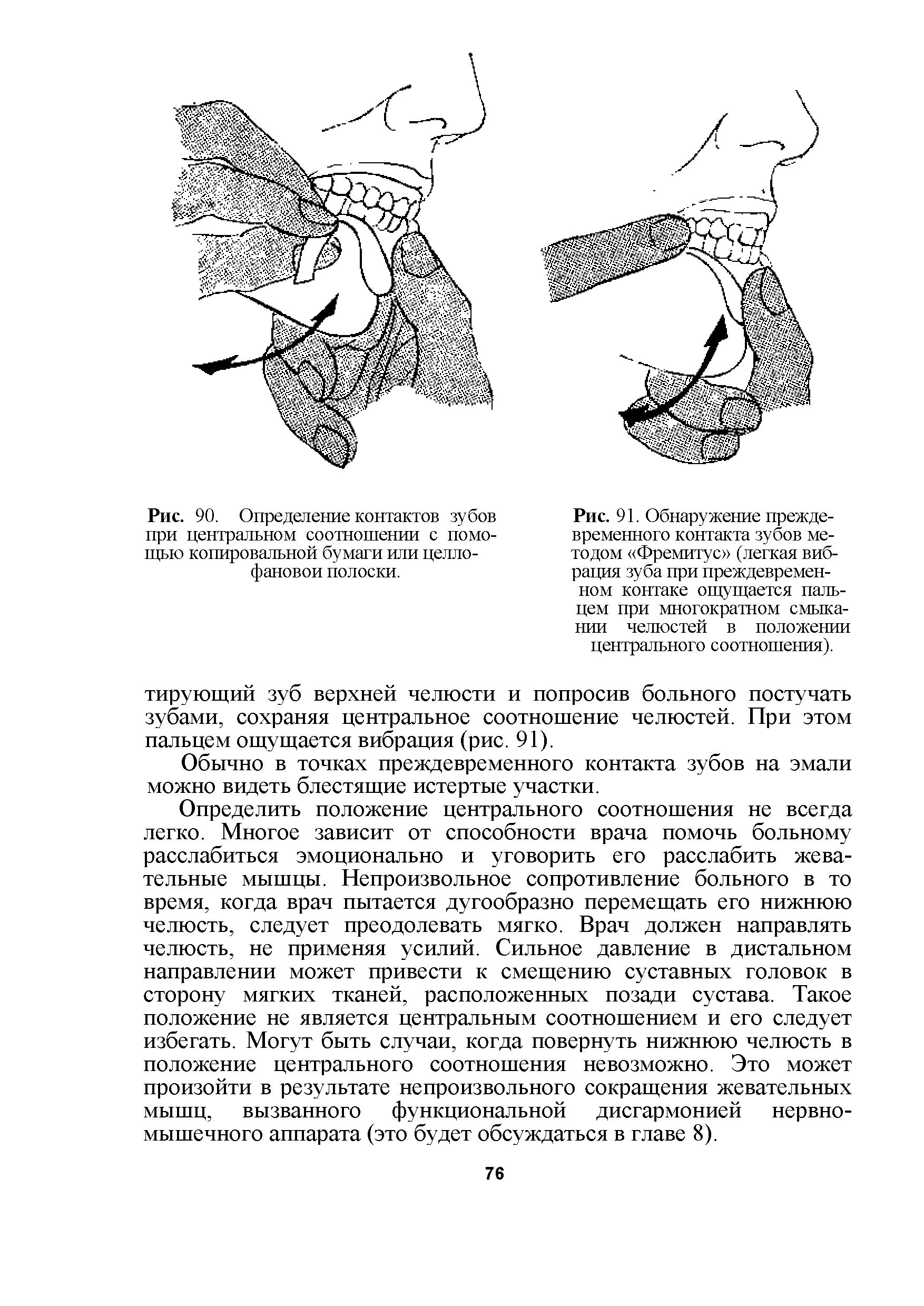 Рис. 91. Обнаружение преждевременного контакта зубов методом Фремитус (легкая вибрация зуба при преждевременном контаке ощущается пальцем при многократном смыкании челюстей в положении центрального соотношения).