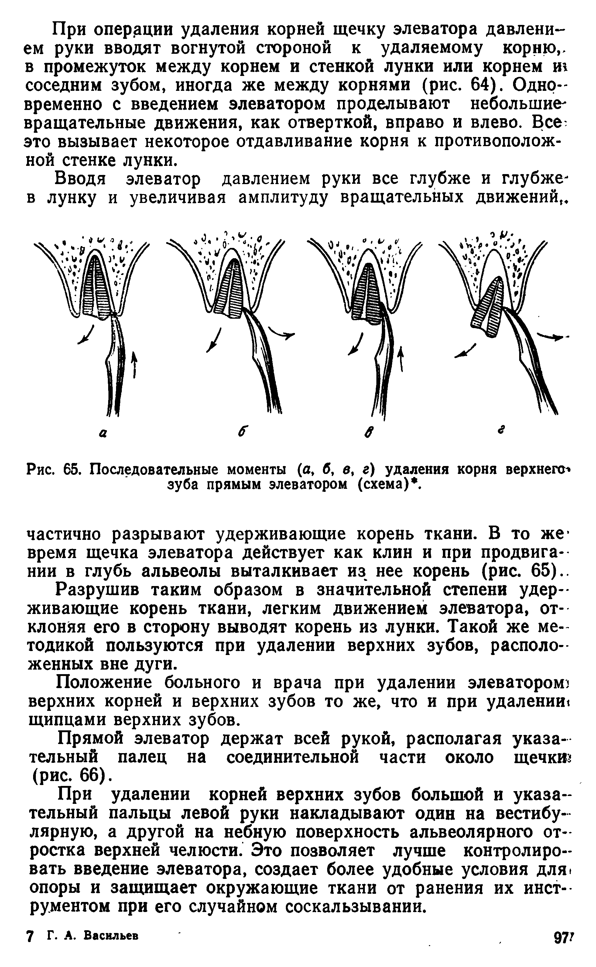 Рис. 65. Последовательные моменты (а, б, в, г) удаления корня верхнего зуба прямым элеватором (схема). ...