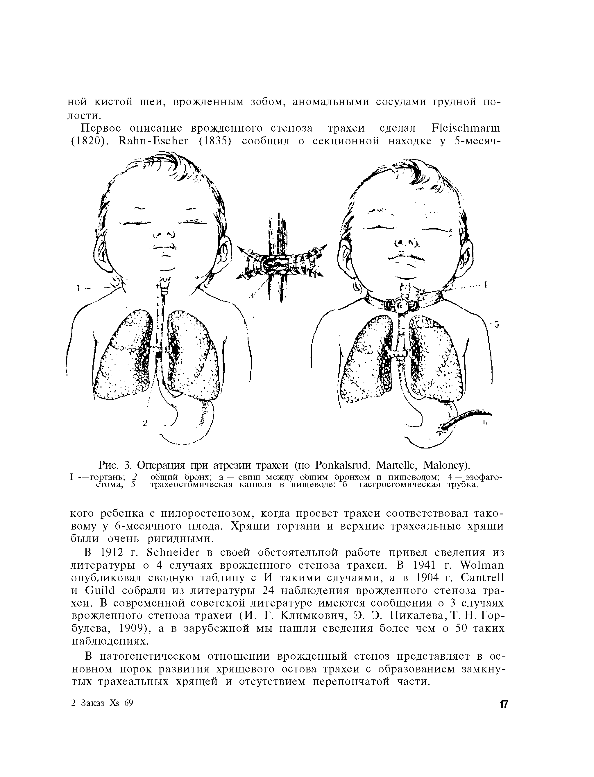 Рис. 3. Операция при атрезии трахеи (но P , M , M ).