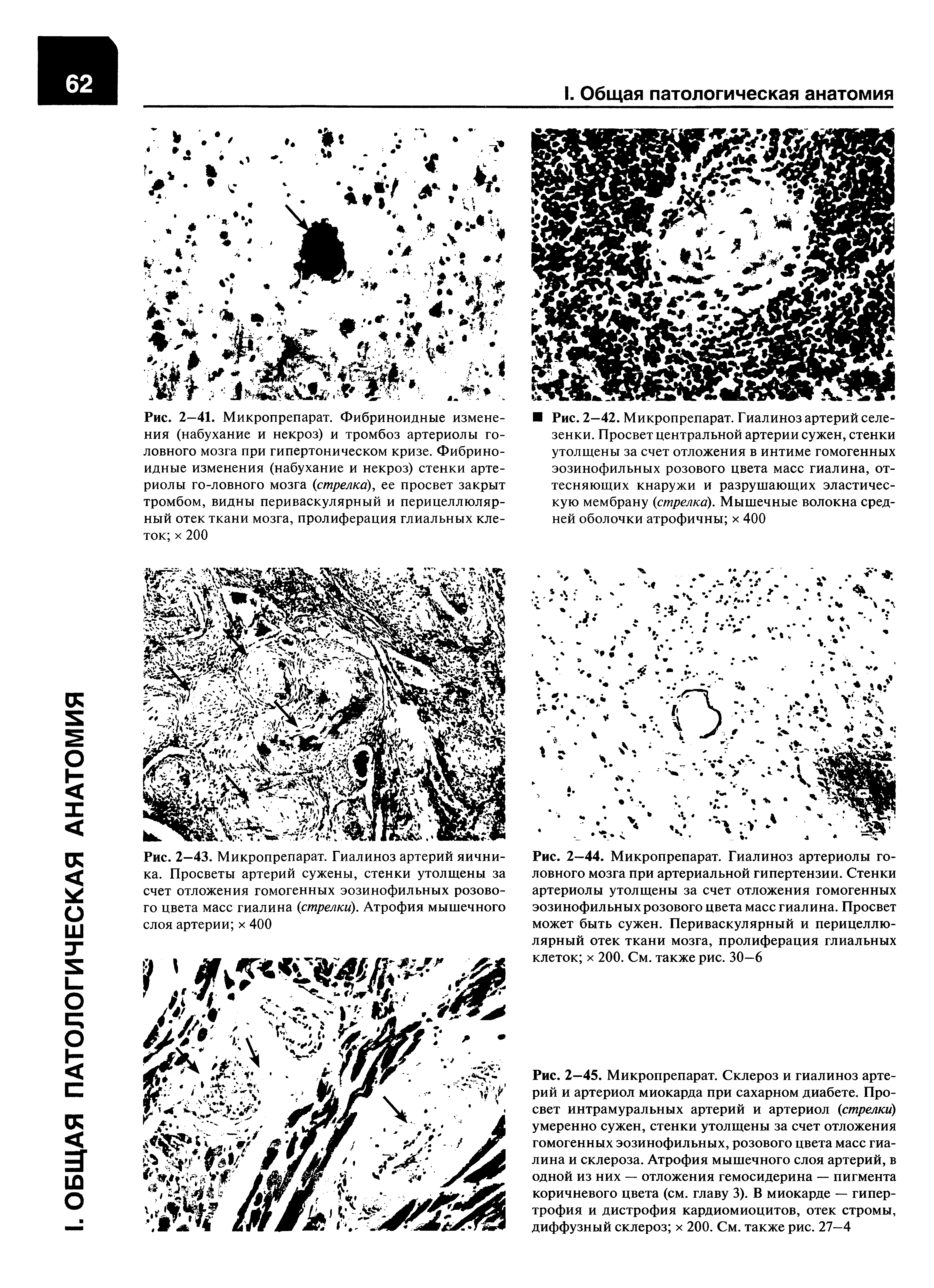 Рис. 2—44. Микропрепарат. Гиалиноз артериолы головного мозга при артериальной гипертензии. Стенки артериолы утолщены за счет отложения гомогенных эозинофильных розового цвета масс гиалина. Просвет может быть сужен. Периваскулярный и перицеллюлярный отек ткани мозга, пролиферация глиальных клеток х 200. См. также рис. 30—6...