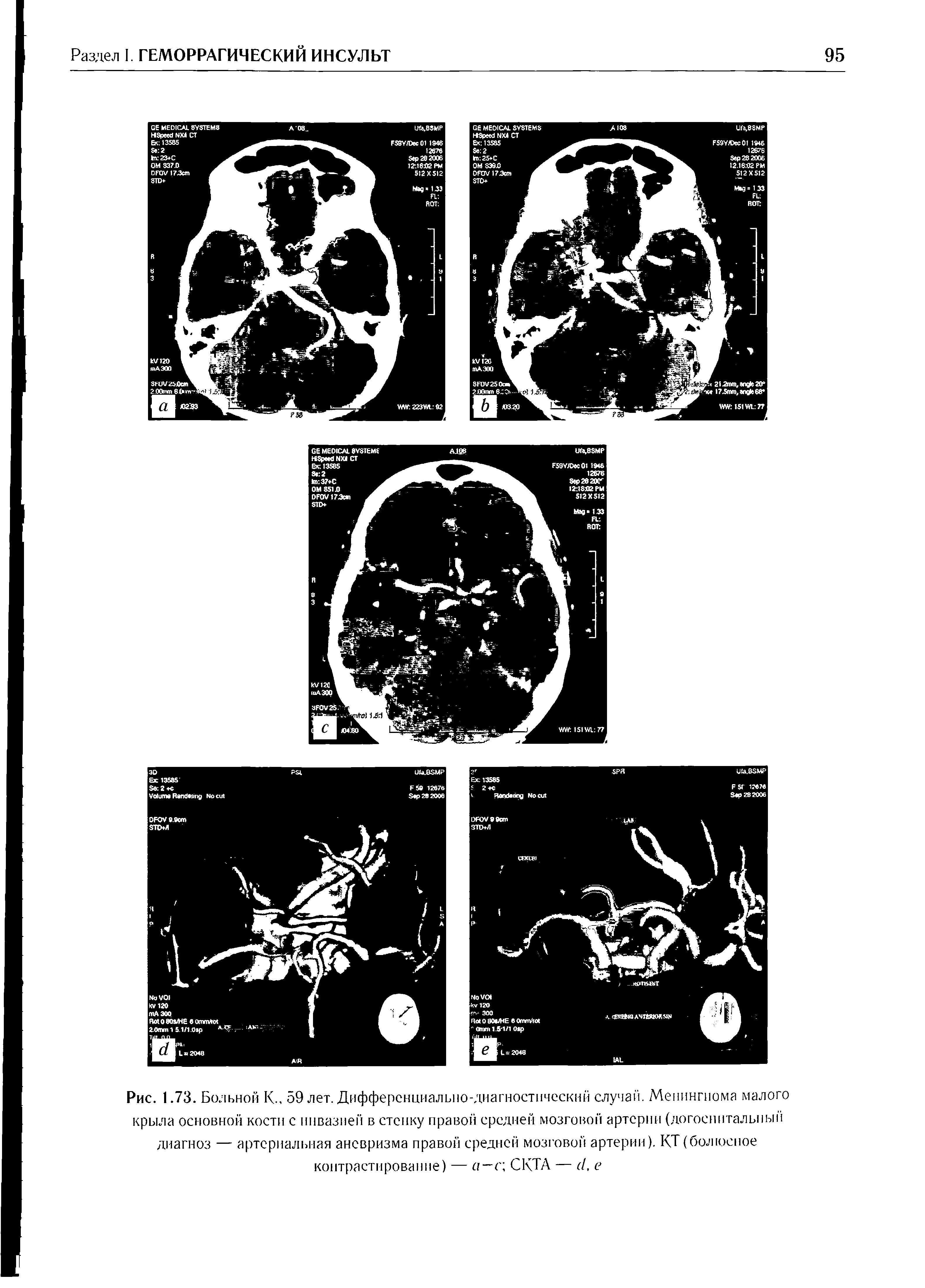 Рис. 1.73. Больной К., 59 лет. Дифференциально-диагностический случай. Менингиома малого крыла основной кости с инвазией в стенку правой средней мозговой артерии (догоспитальный диагноз — артериальная аневризма правой средней мозговой артерии). КТ (болюсное контрастирование) — а—с СКТА — 7, е...