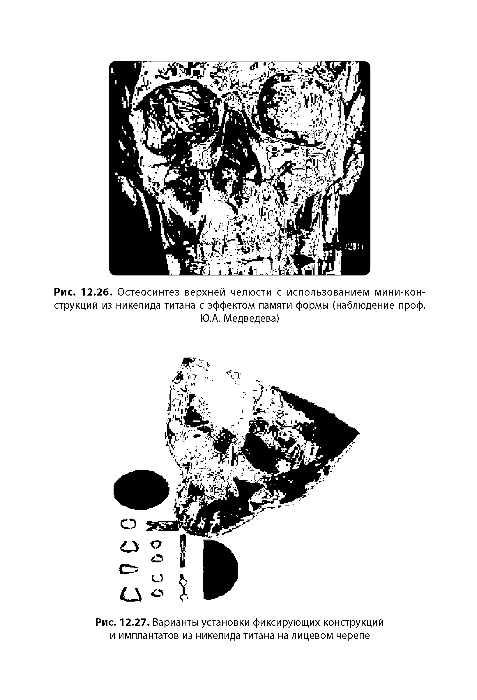 Рис. 12.27. Варианты установки фиксирующих конструкций и имплантатов из никелида титана на лицевом черепе...