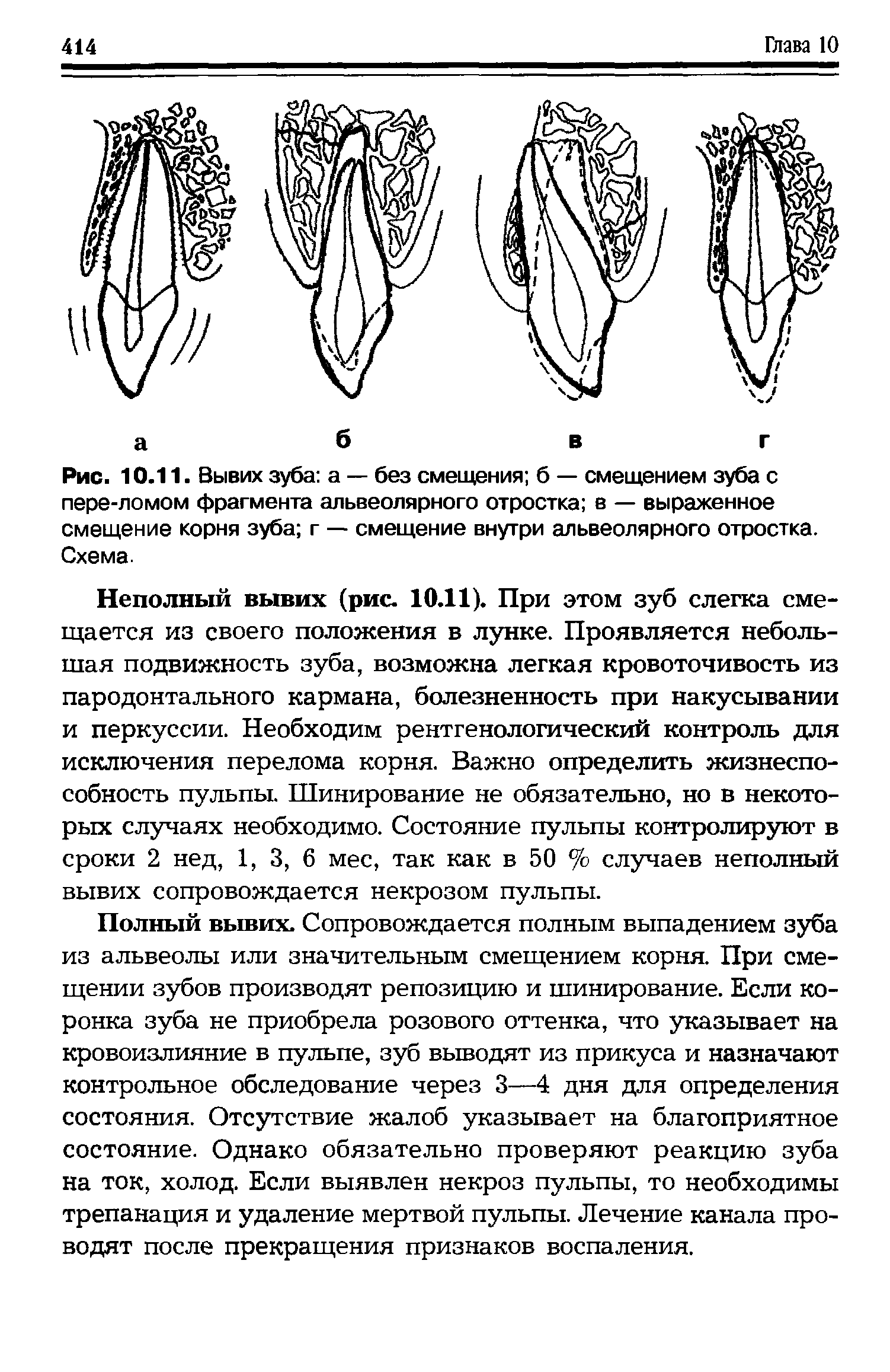 Рис. 10.11. Вывих зуба а — без смещения б — смещением зуба с пере-ломом фрагмента альвеолярного отростка в — выраженное смещение корня зуба г — смещение внутри альвеолярного отростка. Схема.