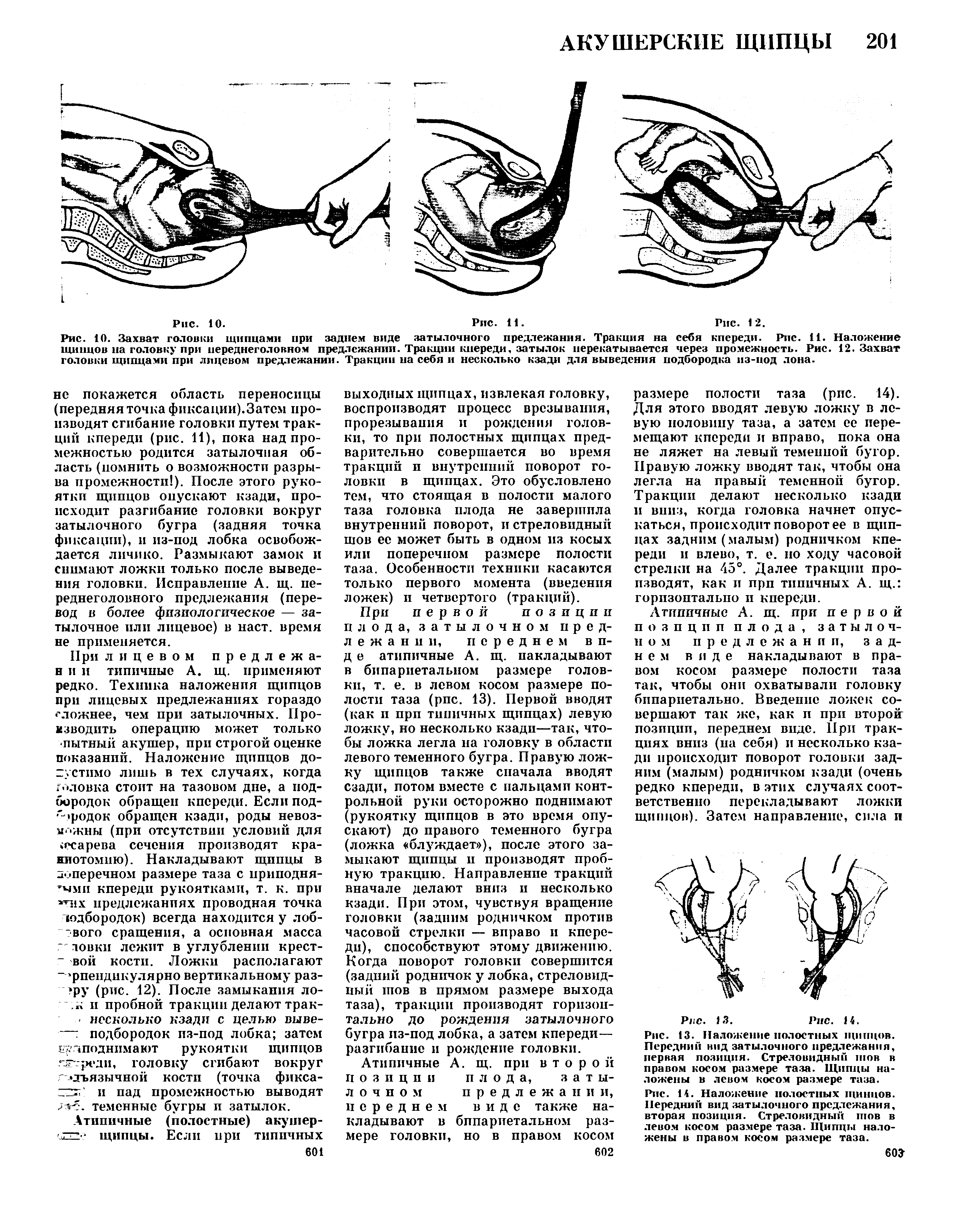 Рис. 13. Наложение полостных щипцов. Передний вид затылочного предлежания, первая позиция. Стреловидный шов в правом косом размере таза. Щипцы наложены в левом косом размере таза.