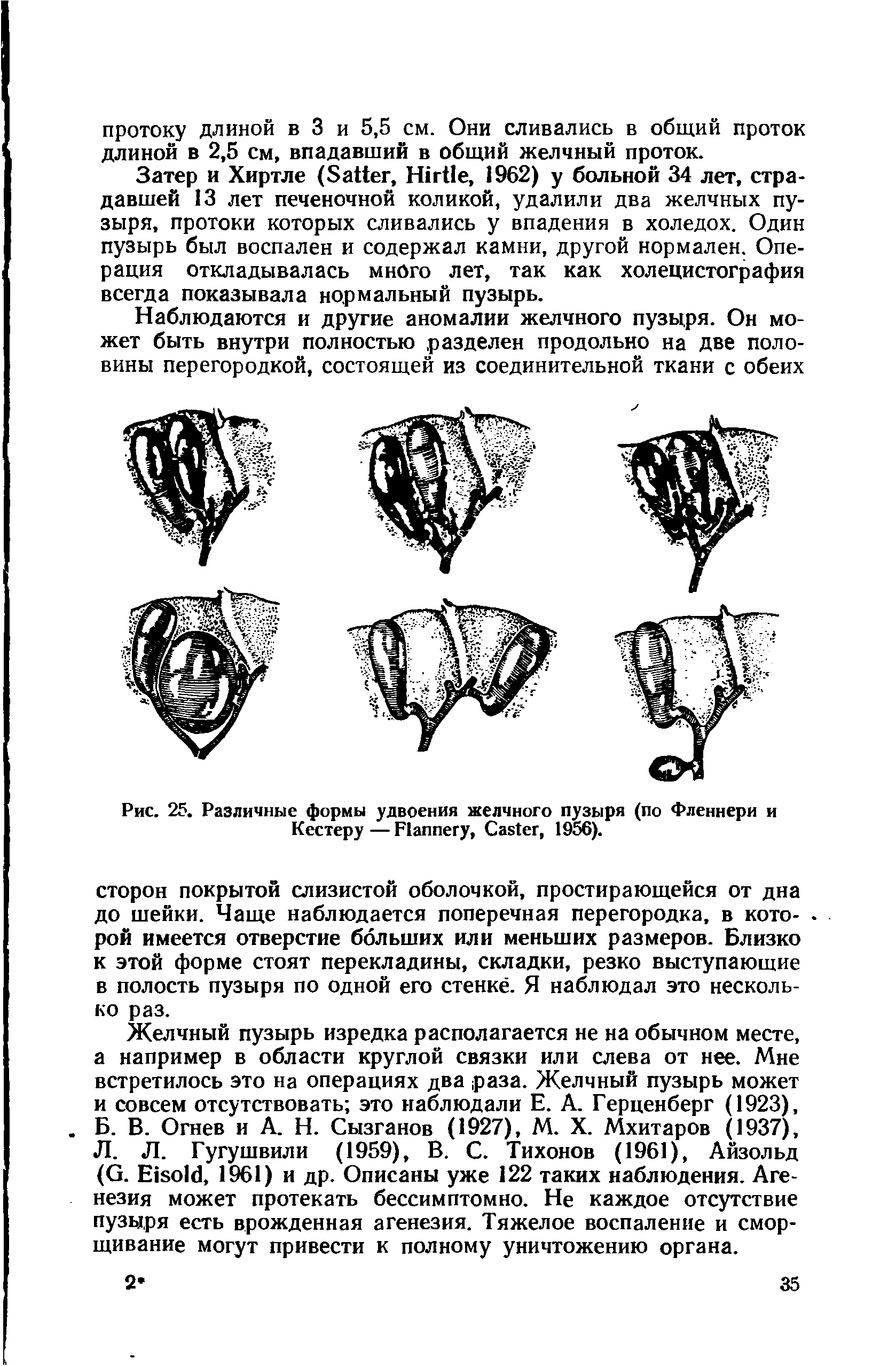 Рис. 25. Различные формы удвоения желчного пузыря (по Фленнери и Кестеру — F , C , 1956).