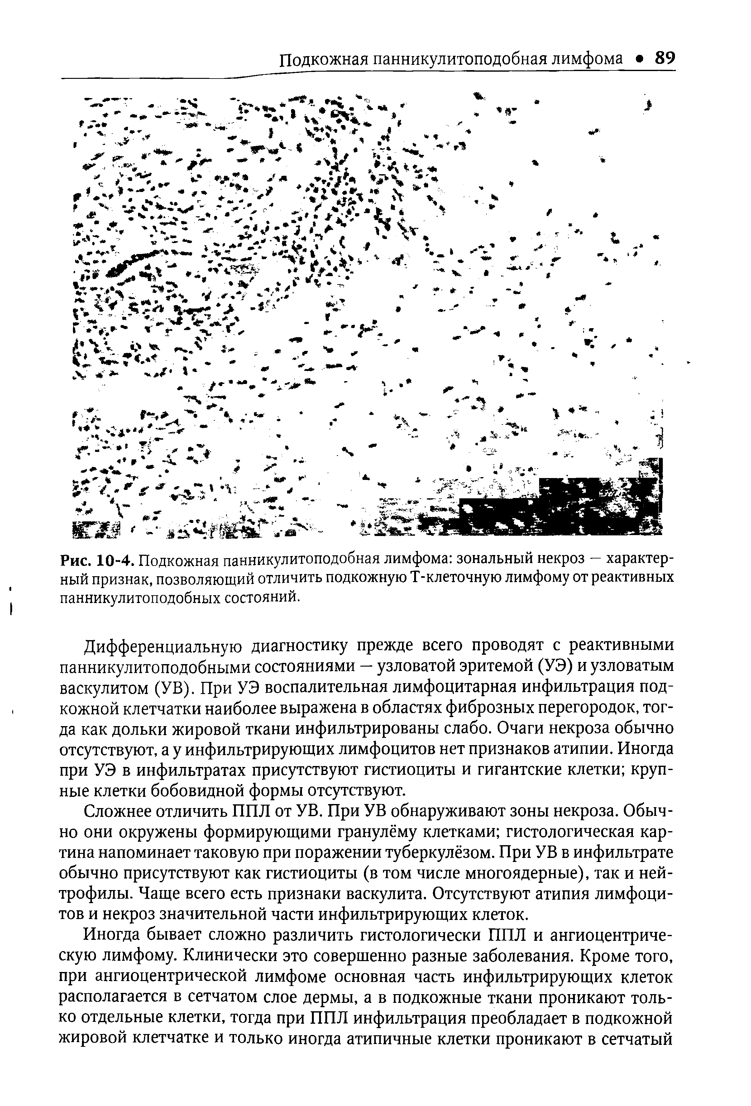 Рис. 10-4. Подкожная панникулитоподобная лимфома зональный некроз — характерный признак, позволяющий отличить подкожную Т-клеточную лимфому от реактивных панникулитоподобных состояний.