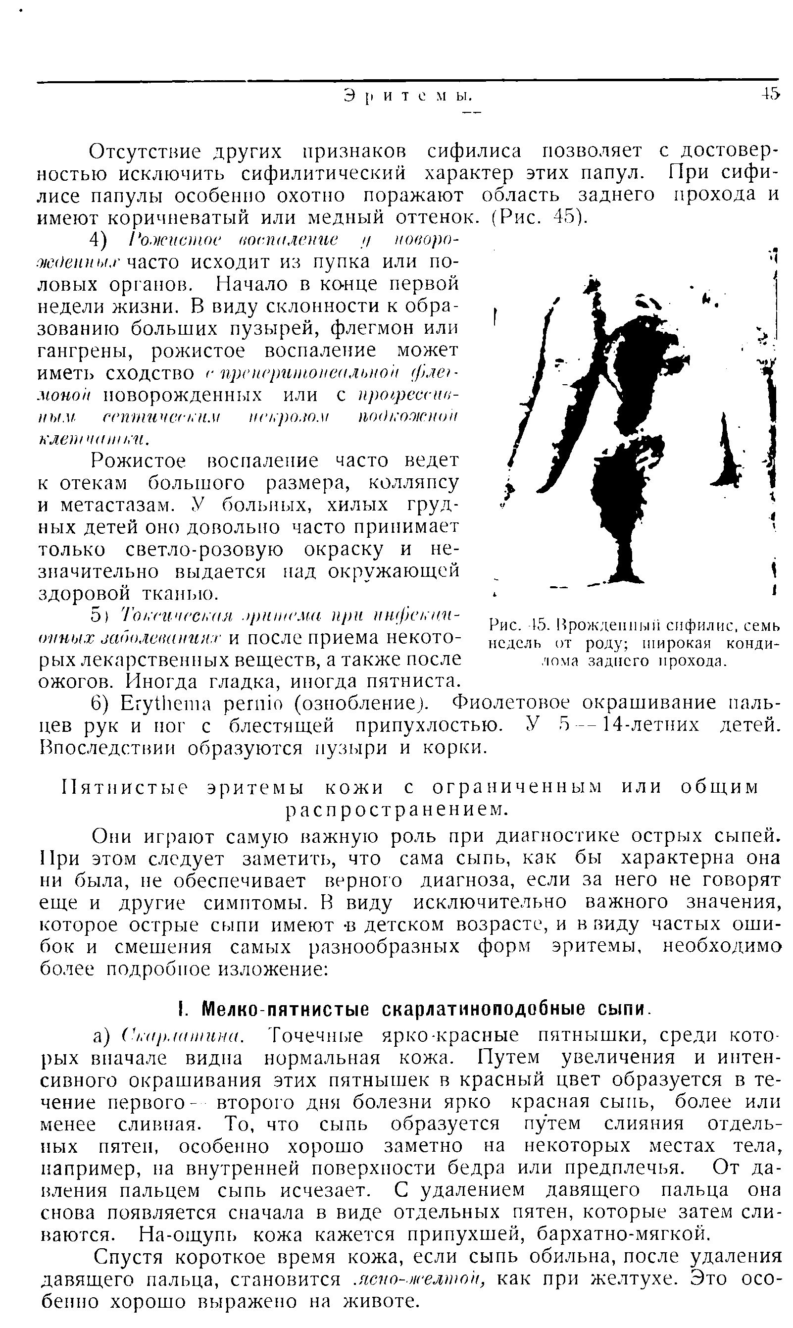 Рис. 45. Врожденный сифилис, семь недель от роду широкая кондилома заднего прохода.