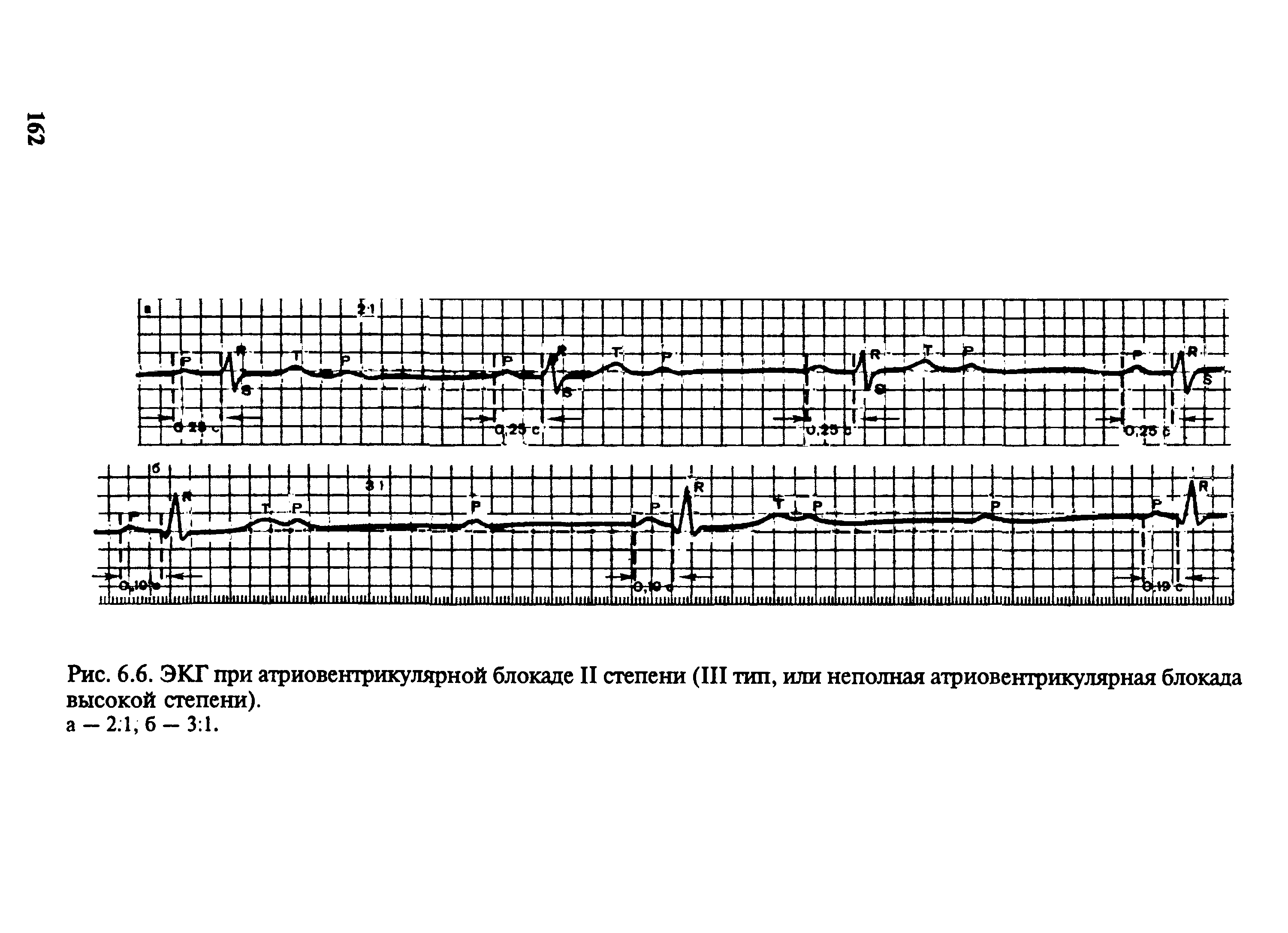 Рис. 6.6. ЭКГ при атриовентрикулярной блокаде II степени (III тип, или неполная атриовентрикулярная блокада высокой степени).