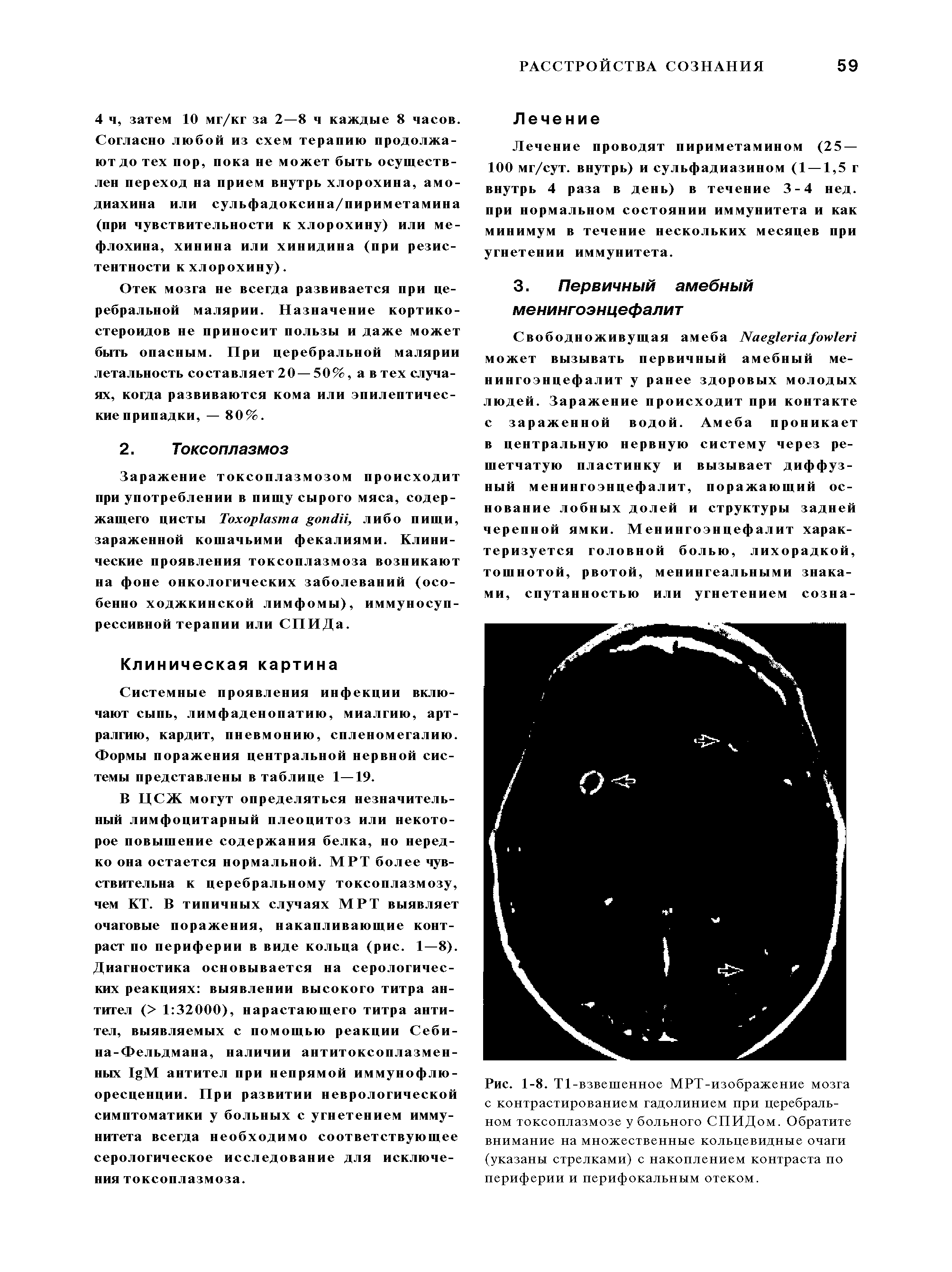 Рис. 1-8. Т1 -взвешенное МРТ-изображение мозга с контрастированием гадолинием при церебральном токсоплазмозе у больного СПИДом. Обратите внимание на множественные кольцевидные очаги (указаны стрелками) с накоплением контраста по периферии и перифокальным отеком.