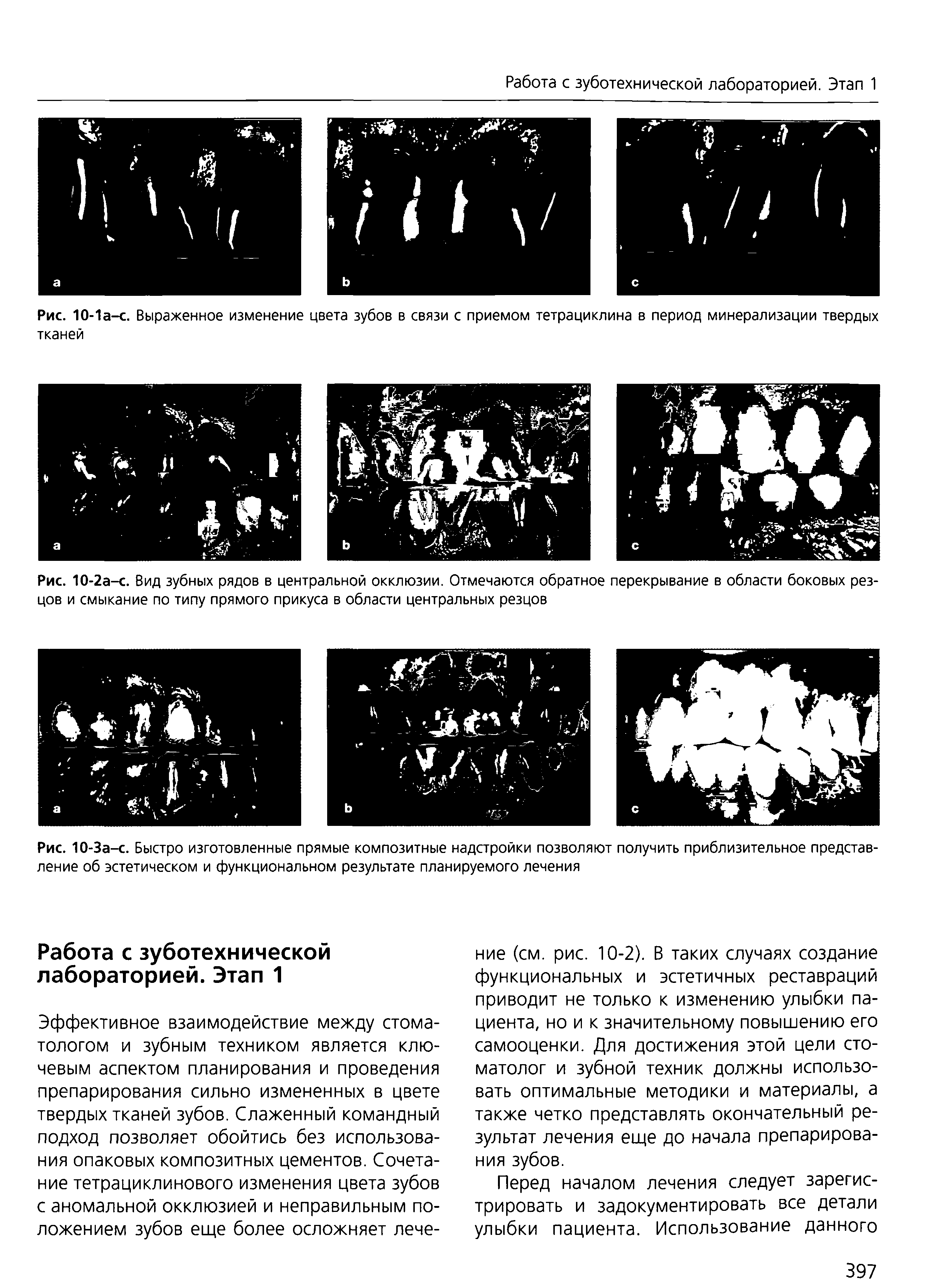 Рис. 10-За-с. Быстро изготовленные прямые композитные надстройки позволяют получить приблизительное представление об эстетическом и функциональном результате планируемого лечения...