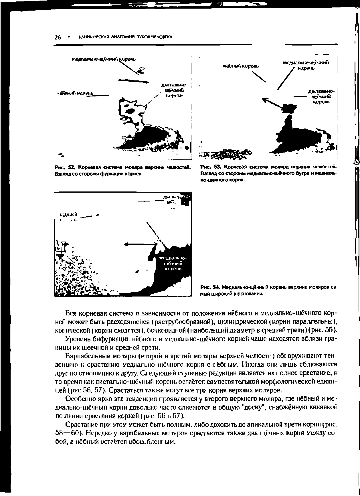 Рис. 54. Медиаяьно-щёчный корень верхних моляров самый широкий в основании.