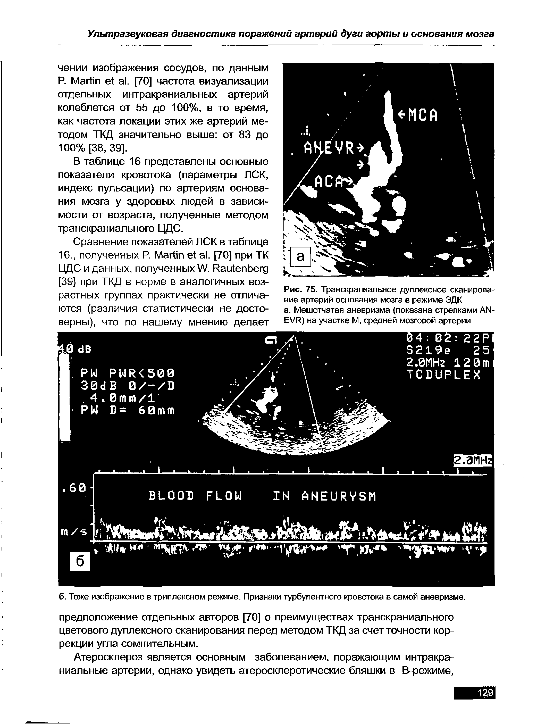 Рис. 75. Транскраниальное дуплексное сканирование артерий основания мозга в режиме ЭДК...