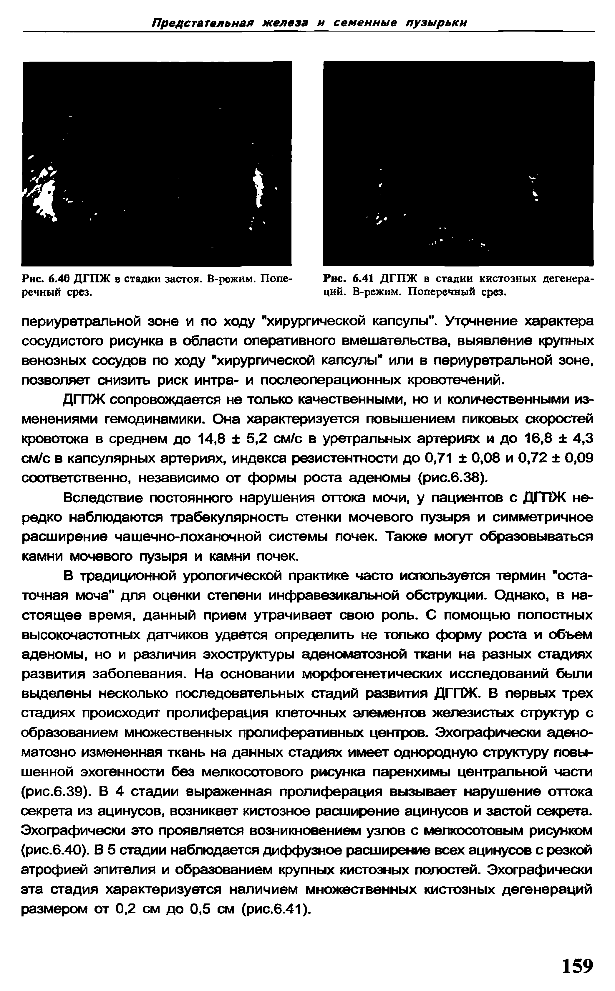 Рис. 6.41 ДГПЖ в стадии кистозных дегенераций. В-режим. Поперечный срез.