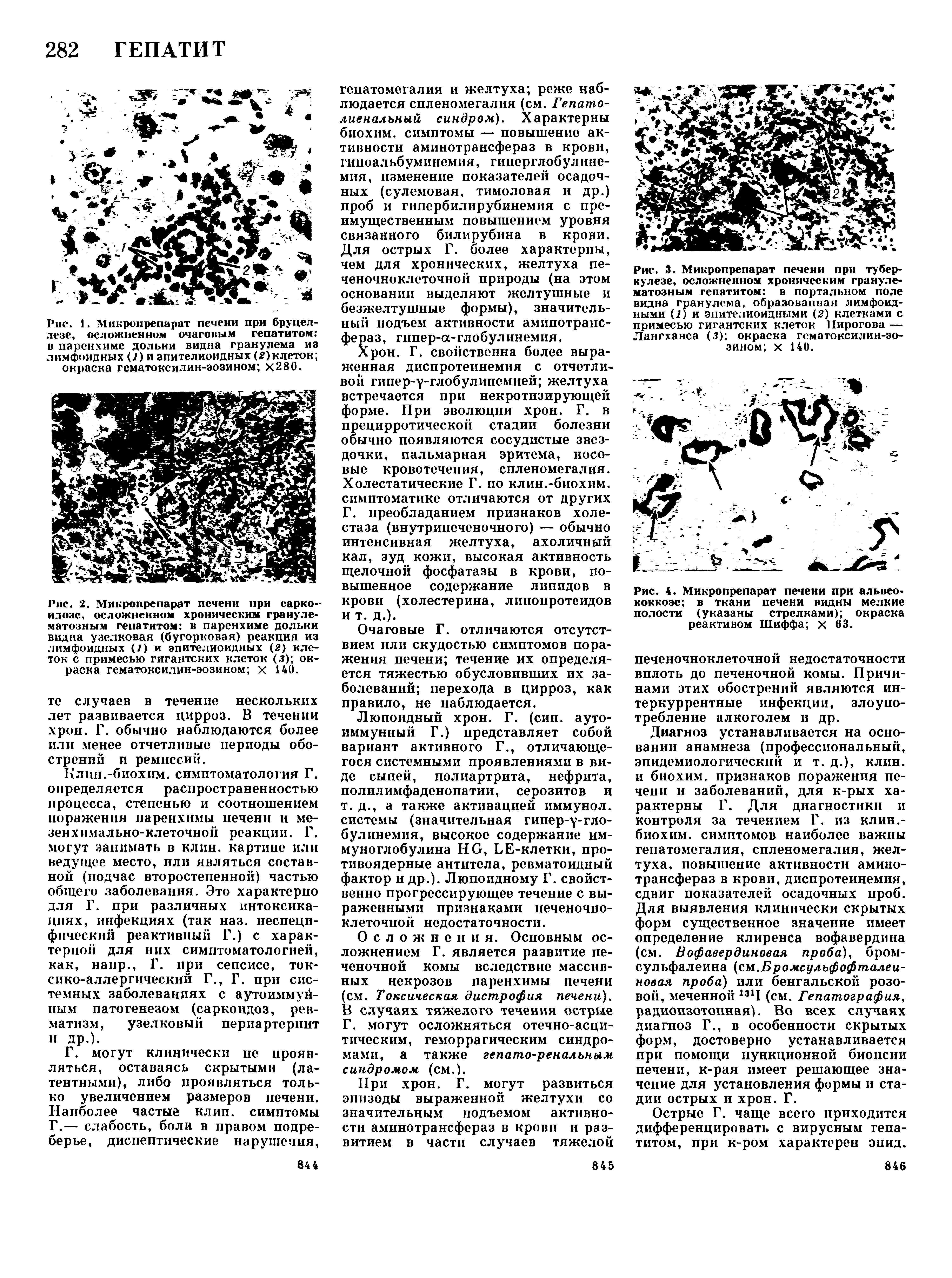 Рис. 2. Микропрепарат печени при саркоидозе, осложненном хроническим гранулематозным гепатитом в паренхиме дольки видна узелковая (бугорковая) реакция из лимфоидных (1) и эпителиоидных (2) клеток с примесью гигантских клеток (. ) окраска гематоксилин-эозином х 140.