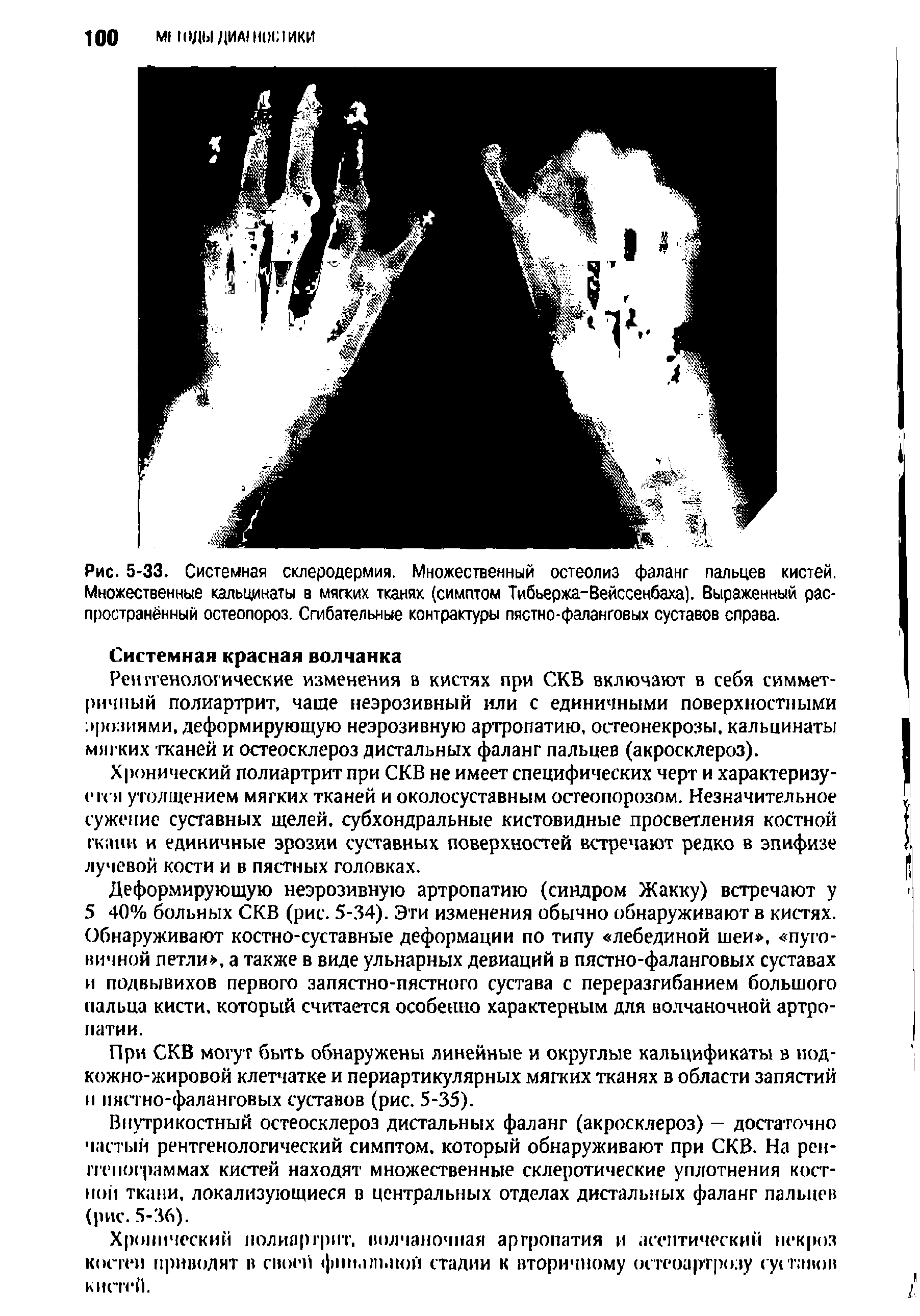 Рис. 5-33. Системная склеродермия. Множественный остеолиз фаланг пальцев кистей. Множественные кальцинаты в мягких тканях (симптом Тибьержа-Вейссенбаха). Выраженный распространённый остеопороз. Сгибательные контрактуры пястно-фаланговых суставов справа.