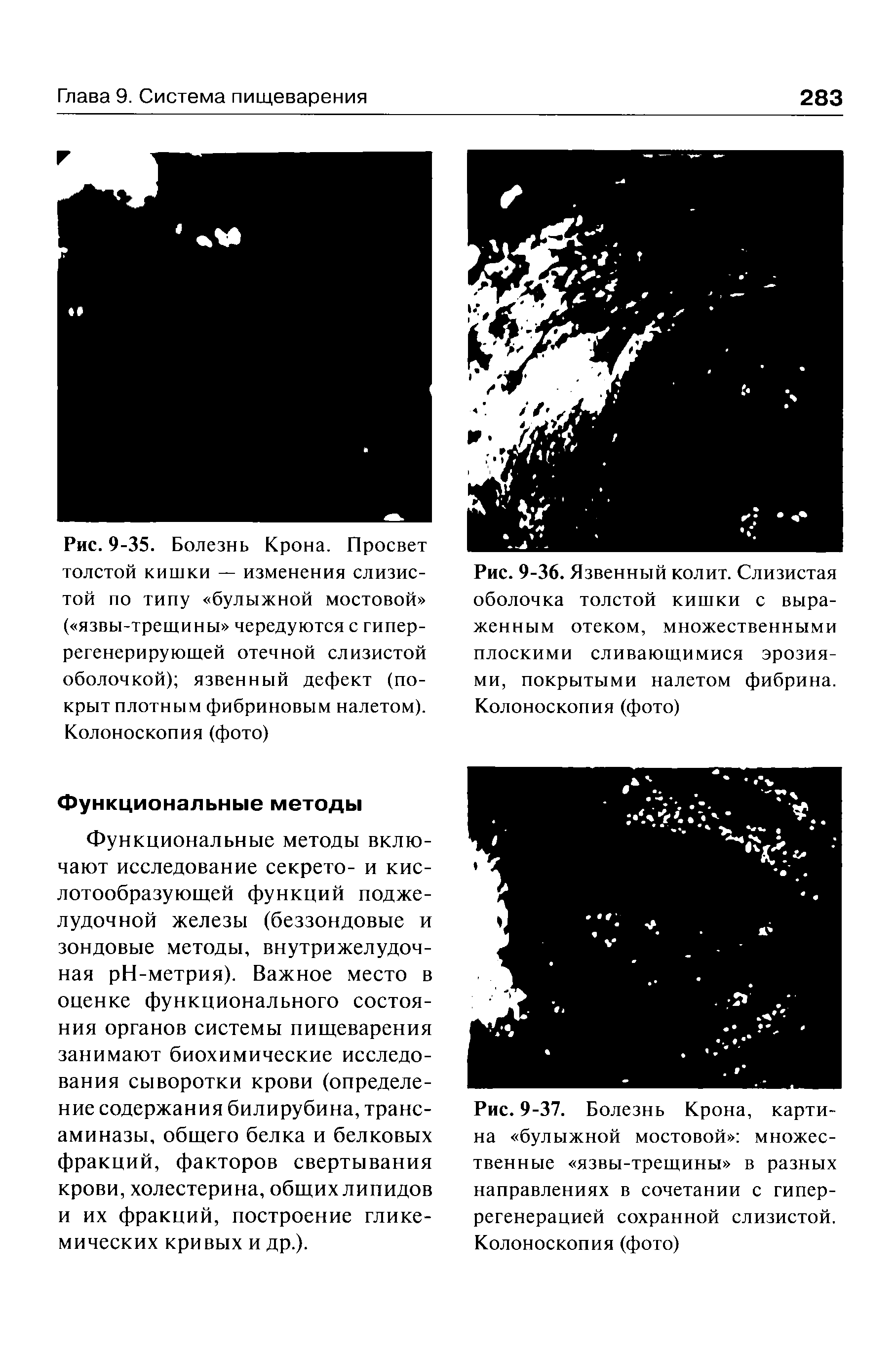 Рис. 9-36. Язвенный колит. Слизистая оболочка толстой кишки с выраженным отеком, множественными...