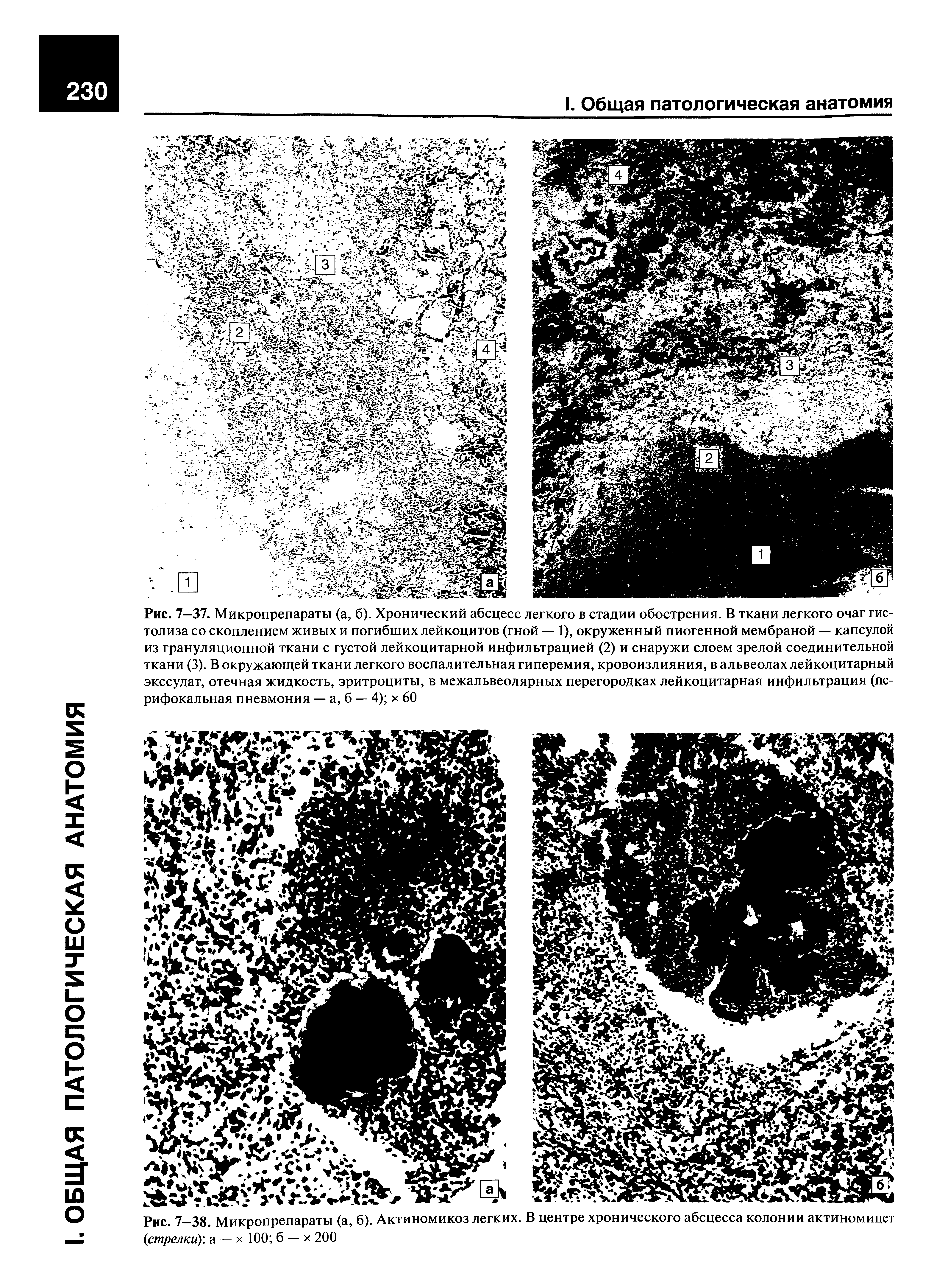 Рис. 7-38. Микропрепараты (а, б). Актиномикоз легких. В центре хронического абсцесса колонии актиномицет (стрелки), а — х 100 б — х 200...