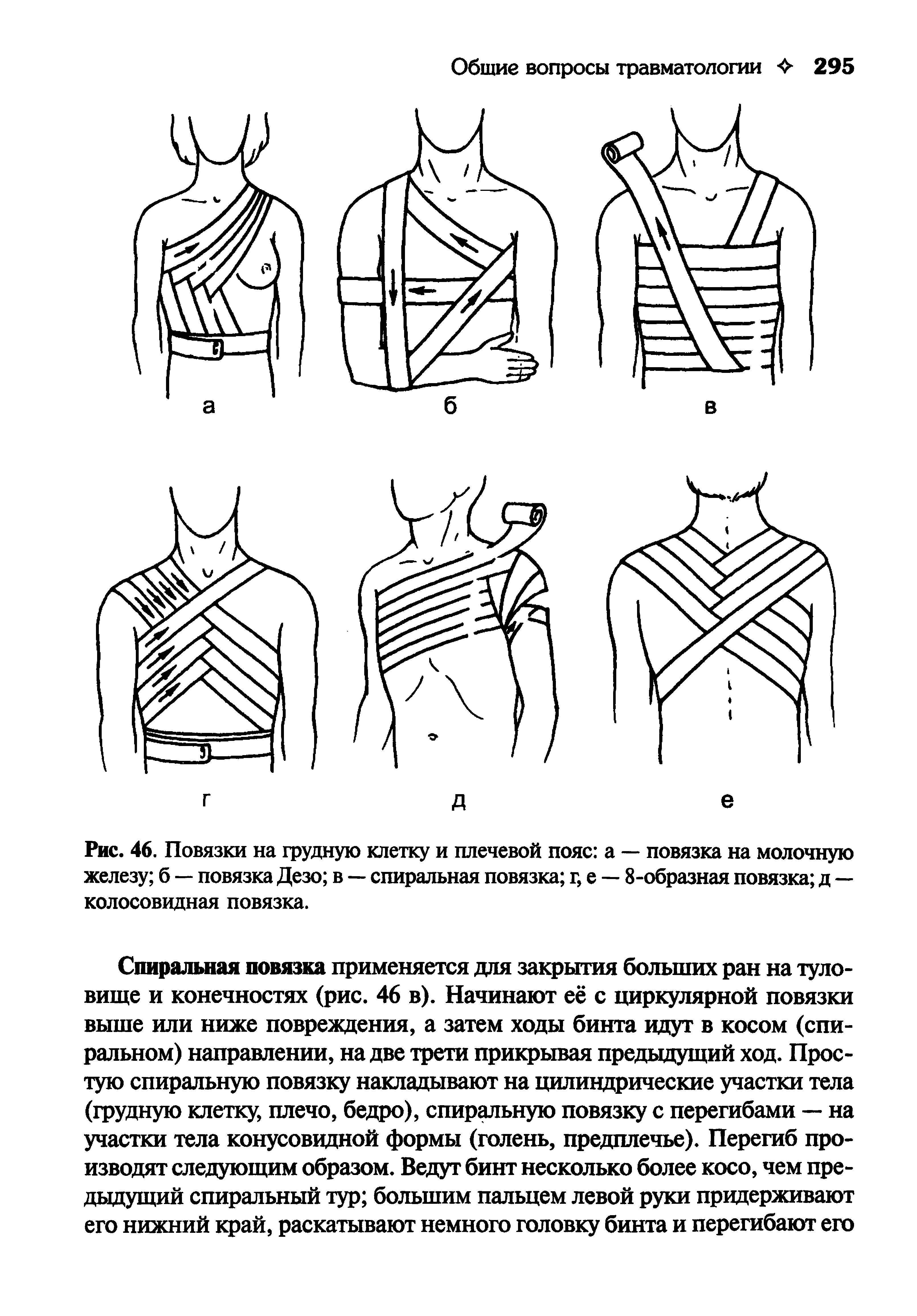Рис. 46. Повязки на грудную клетку и плечевой пояс а — повязка на молочную железу б — повязка Дезо в — спиральная повязка г, е — 8-образная повязка д — колосовидная повязка.