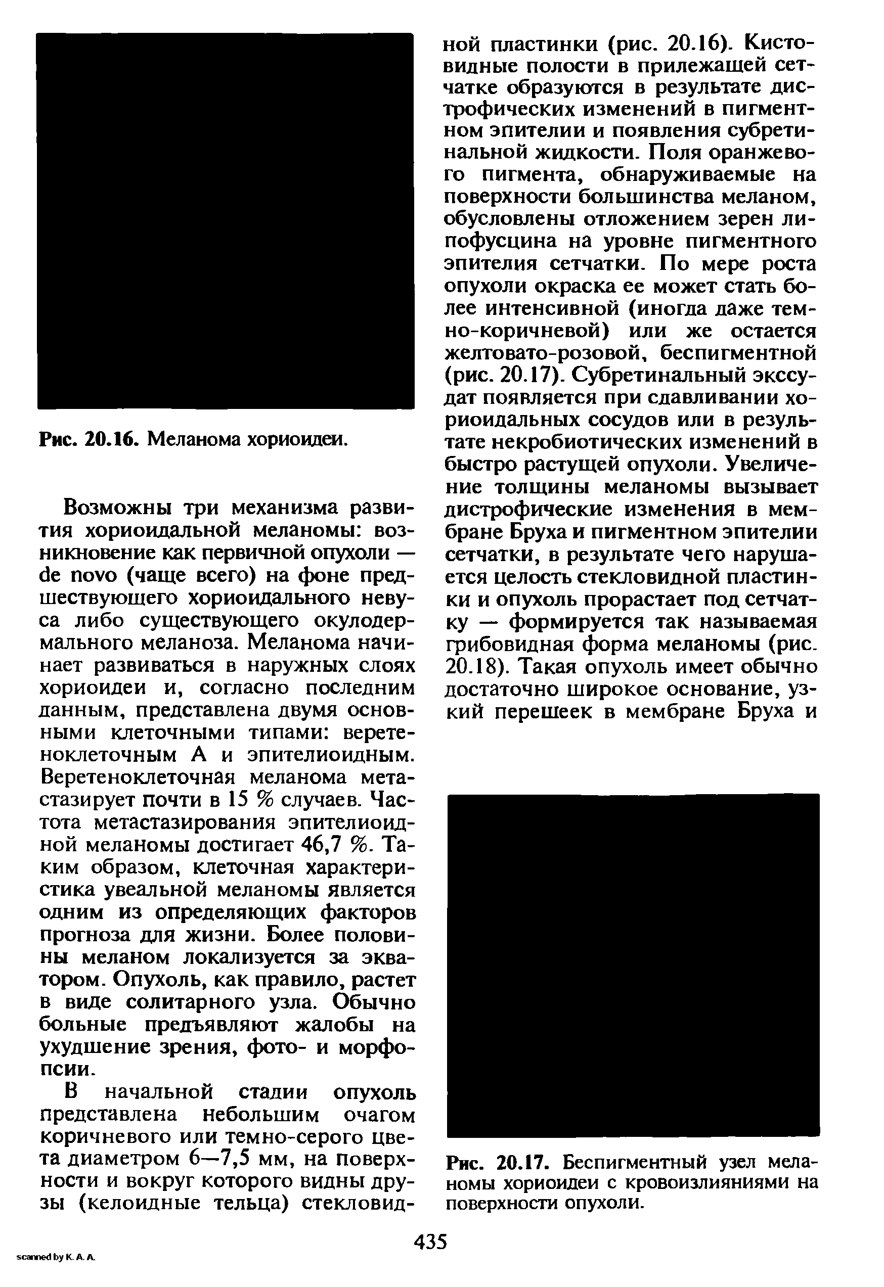 Рис. 20.17. Беспигментный узел меланомы хориоидеи с кровоизлияниями на поверхности опухоли.