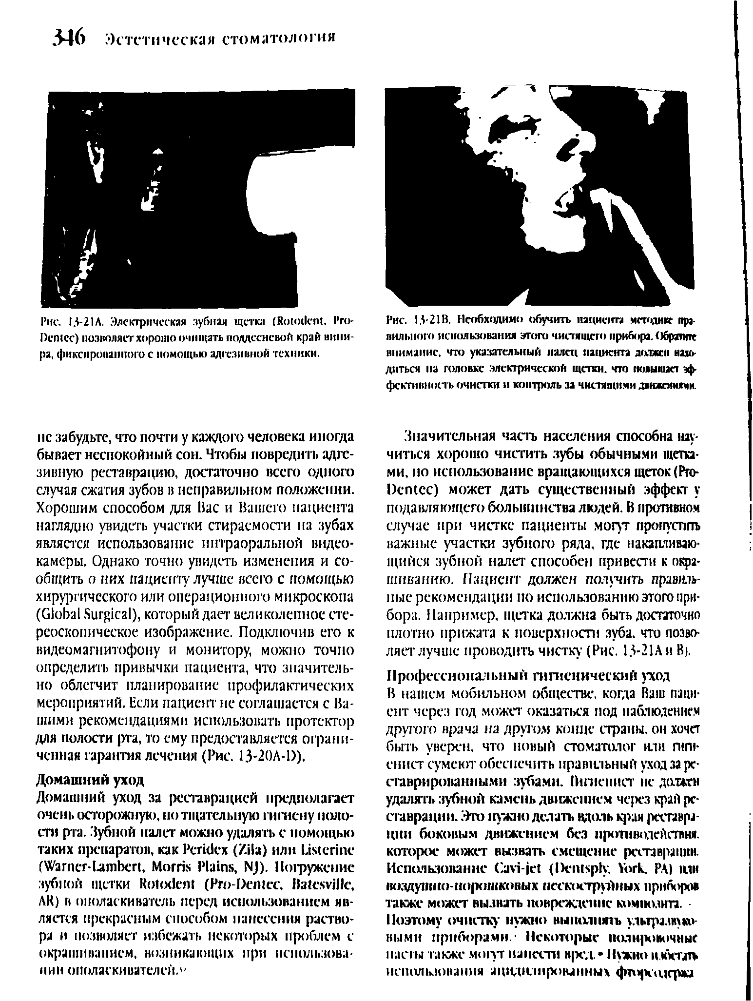 Рис. 13-21Л. Электрическая зубная щетка (R - . P -D ) позволяет хорошо о-цццап. поддесневой край виии-ра, фиксированного с помощью адгезивной техники.