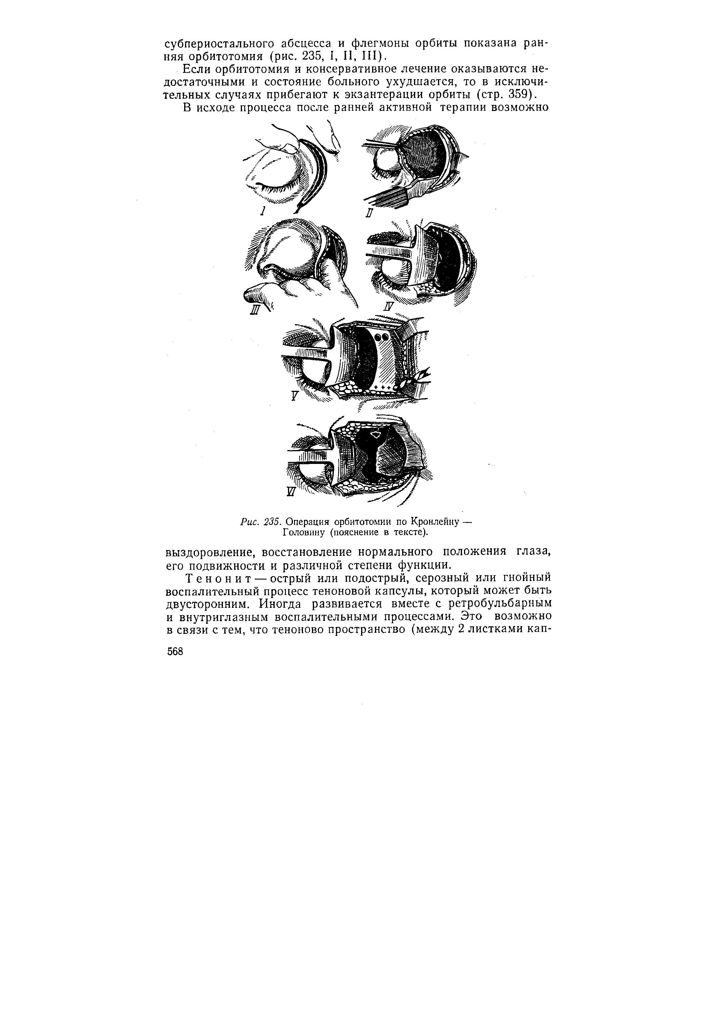 Рис. 235. Операция орбитотомии по Кронлейну — Головину (пояснение в тексте).