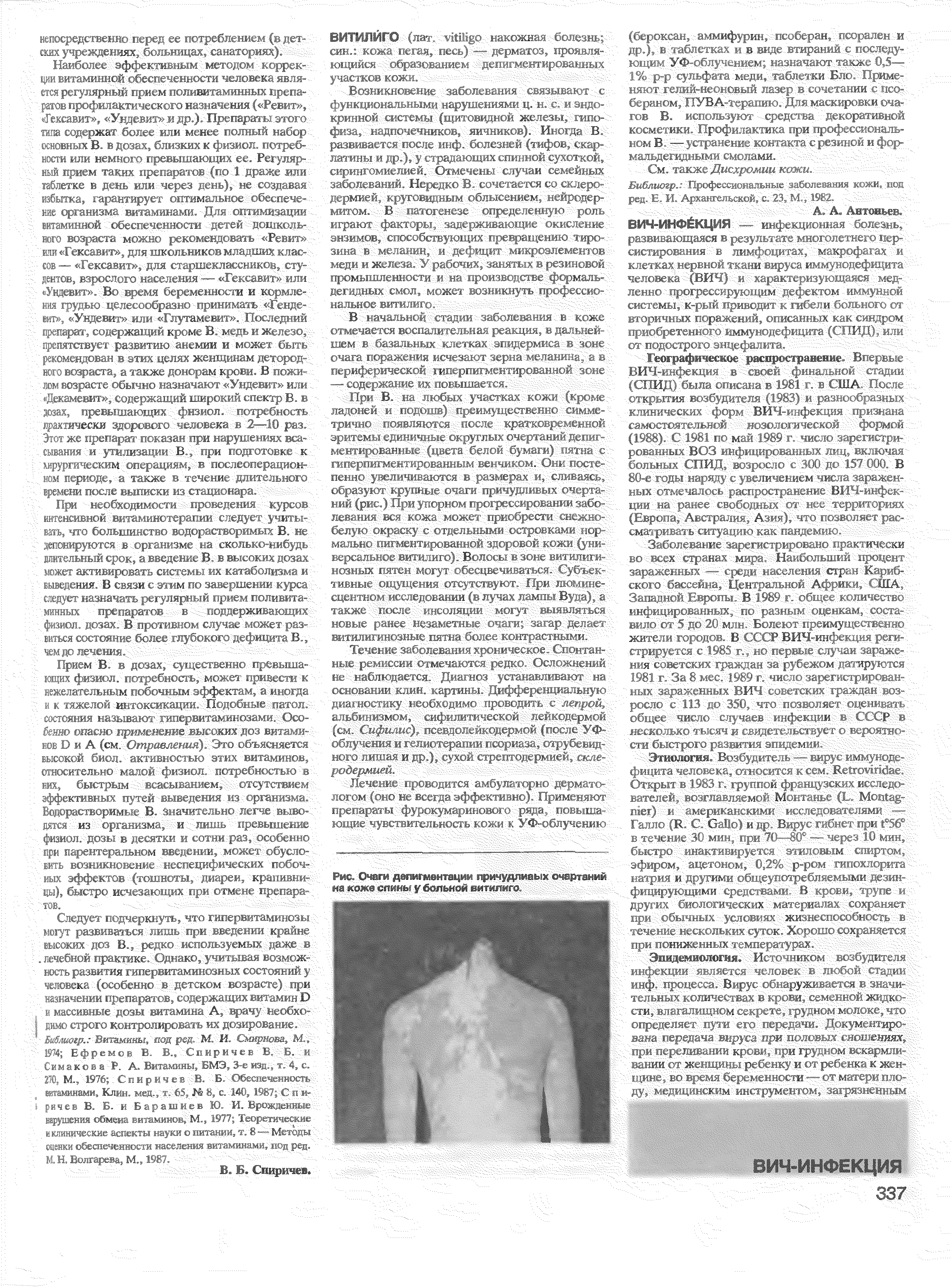 Рис. Очаги депигментации причудливых очертании на коже слииы у больной витилиго.