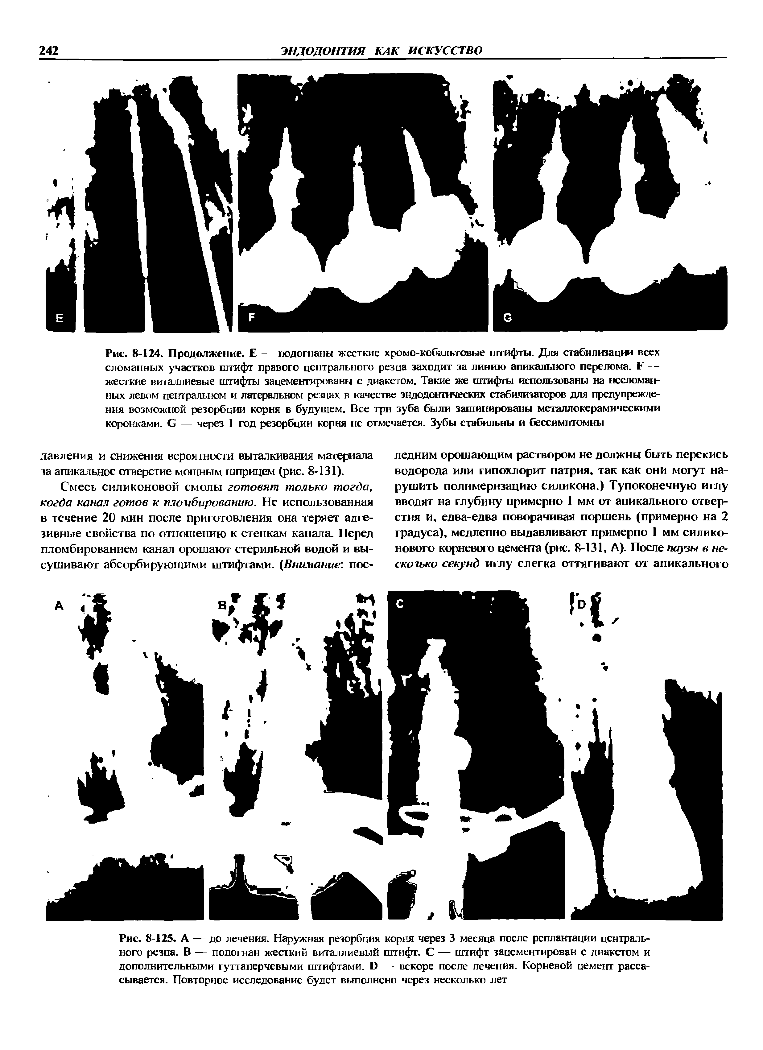 Рис. 8-125. А — до лечения. Наружная резорбция корня через 3 месяца после реплантации центрального резца. В — подогнан жесткий виталлиевый штифт. С — штифт зацементирован с диакетом и дополнительными гуттаперчевыми штифтами. О — вскоре после лечения. Корневой цемент рассасывается. Повторное исследование будет выполнено через несколько лет...