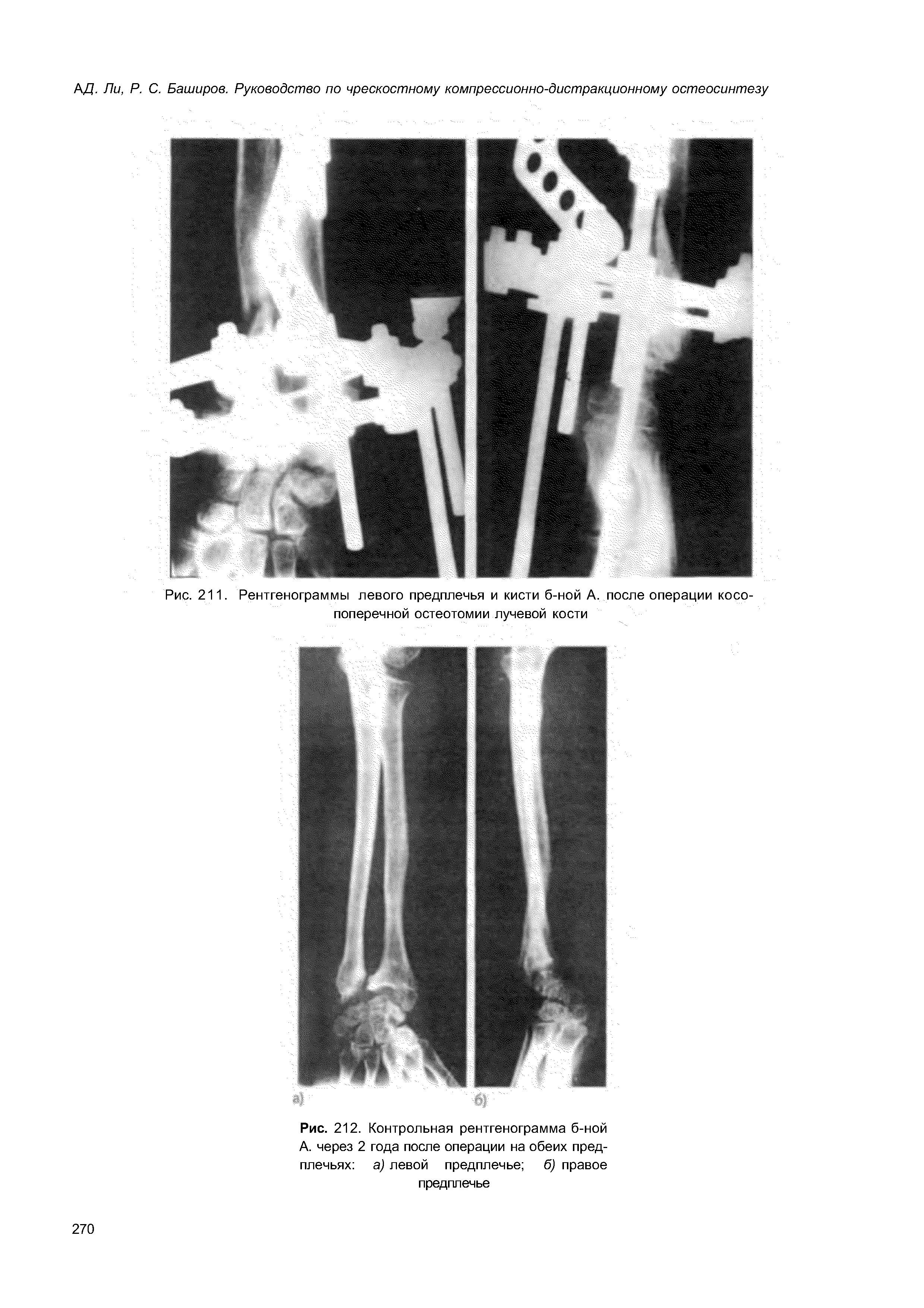 Рис. 211. Рентгенограммы левого предплечья и кисти б-ной А. после операции косопоперечной остеотомии лучевой кости...