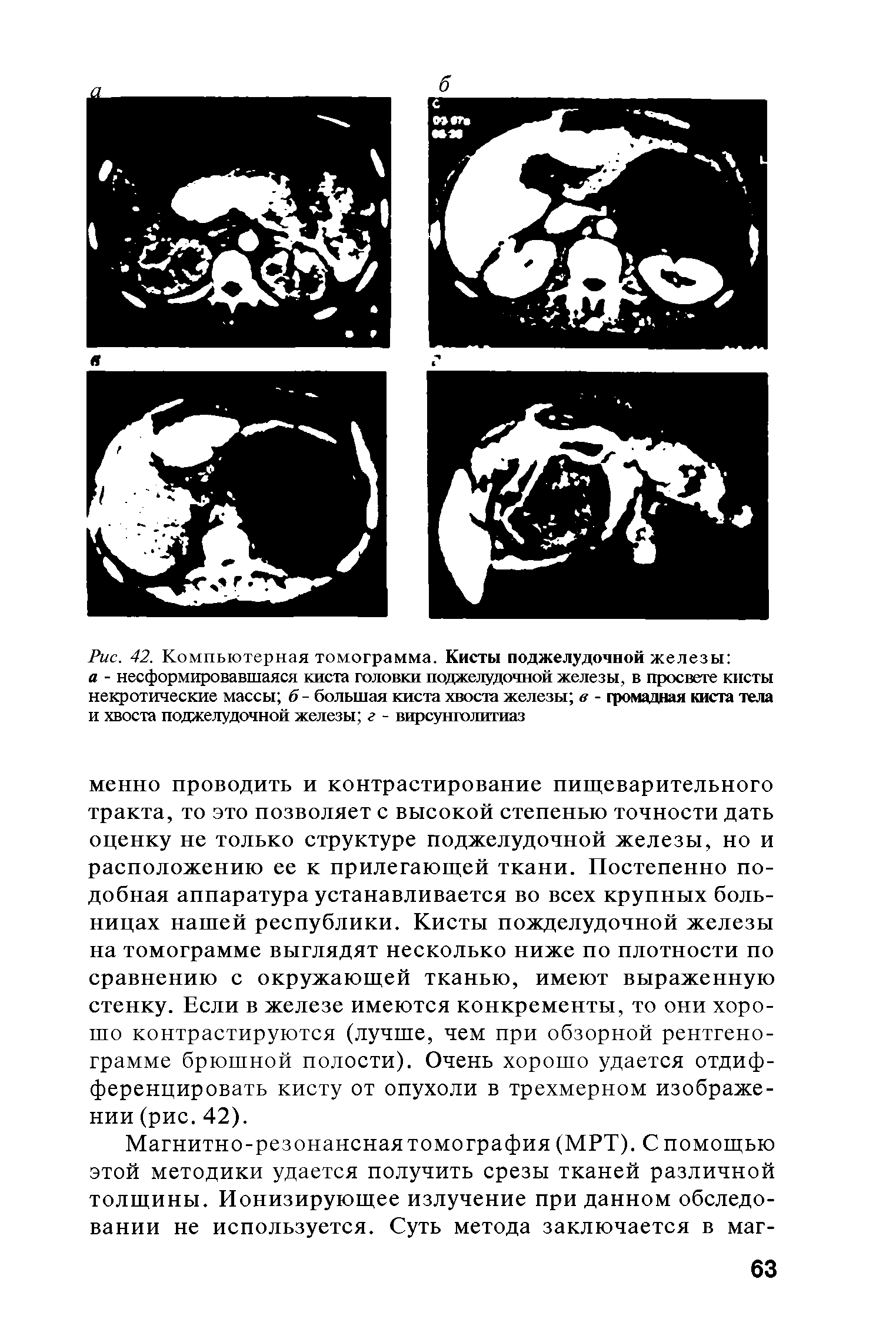 Рис. 42. Компьютерная томограмма. Кисты поджелудочной железы а - сформировавшаяся киста головки поджелудочной железы, в просвете кисты некротические массы б - большая киста хвоста железы в - громадная киста тела и хвоста поджелудочной железы г - вирсунголитиаз...