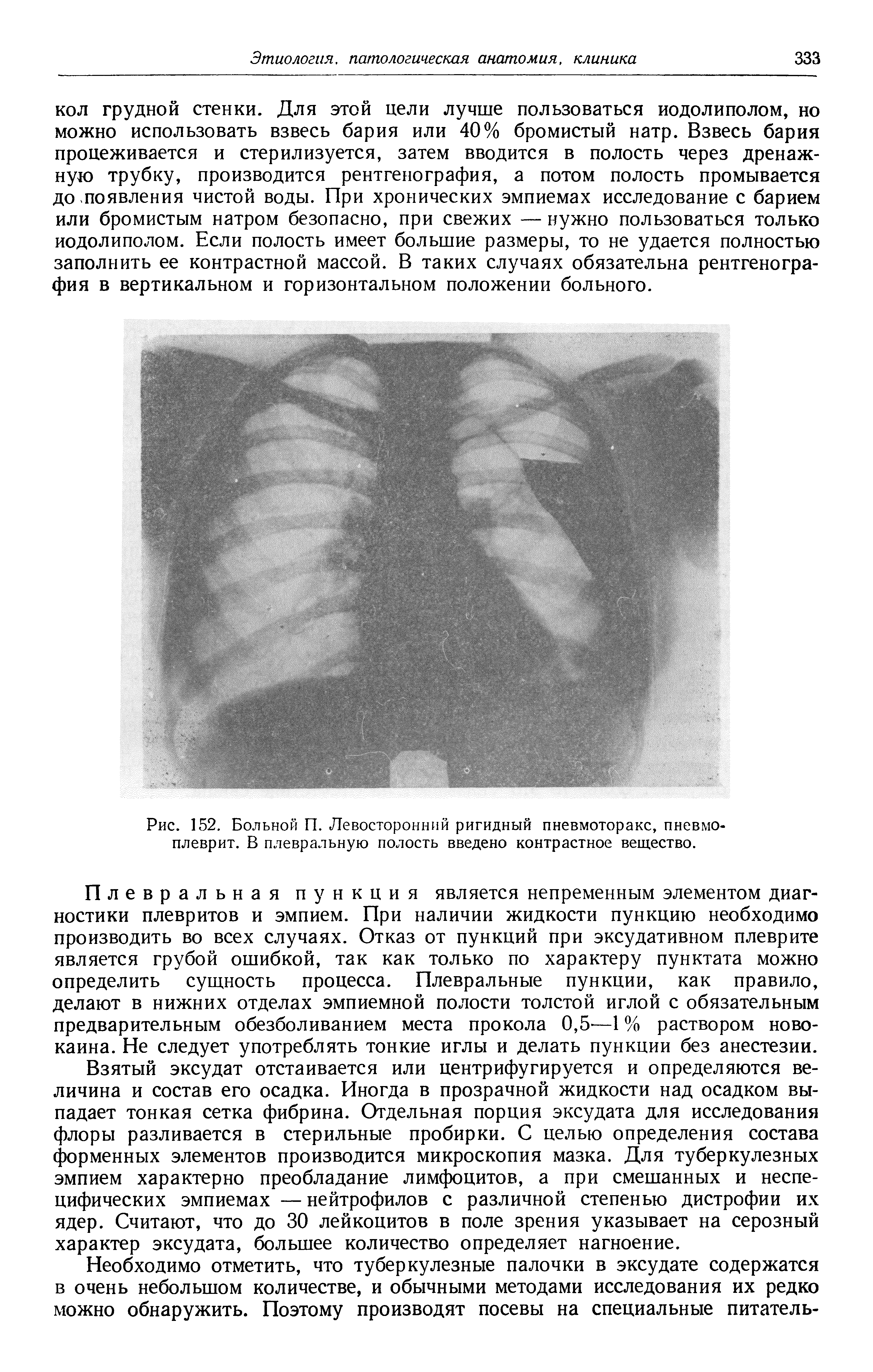 Рис. 152. Больной П. Левосторонний ригидный пневмоторакс, пневмоплеврит. В плевральную полость введено контрастное вещество.