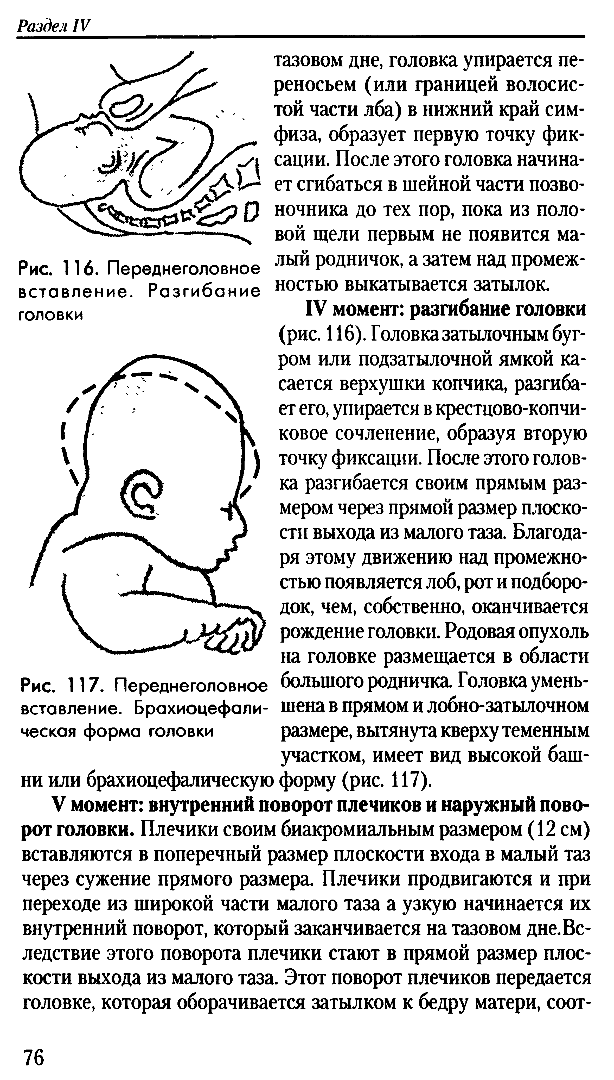 Рис. 117. Переднеголовное вставление. Брахиоцефали-ческая форма головки...