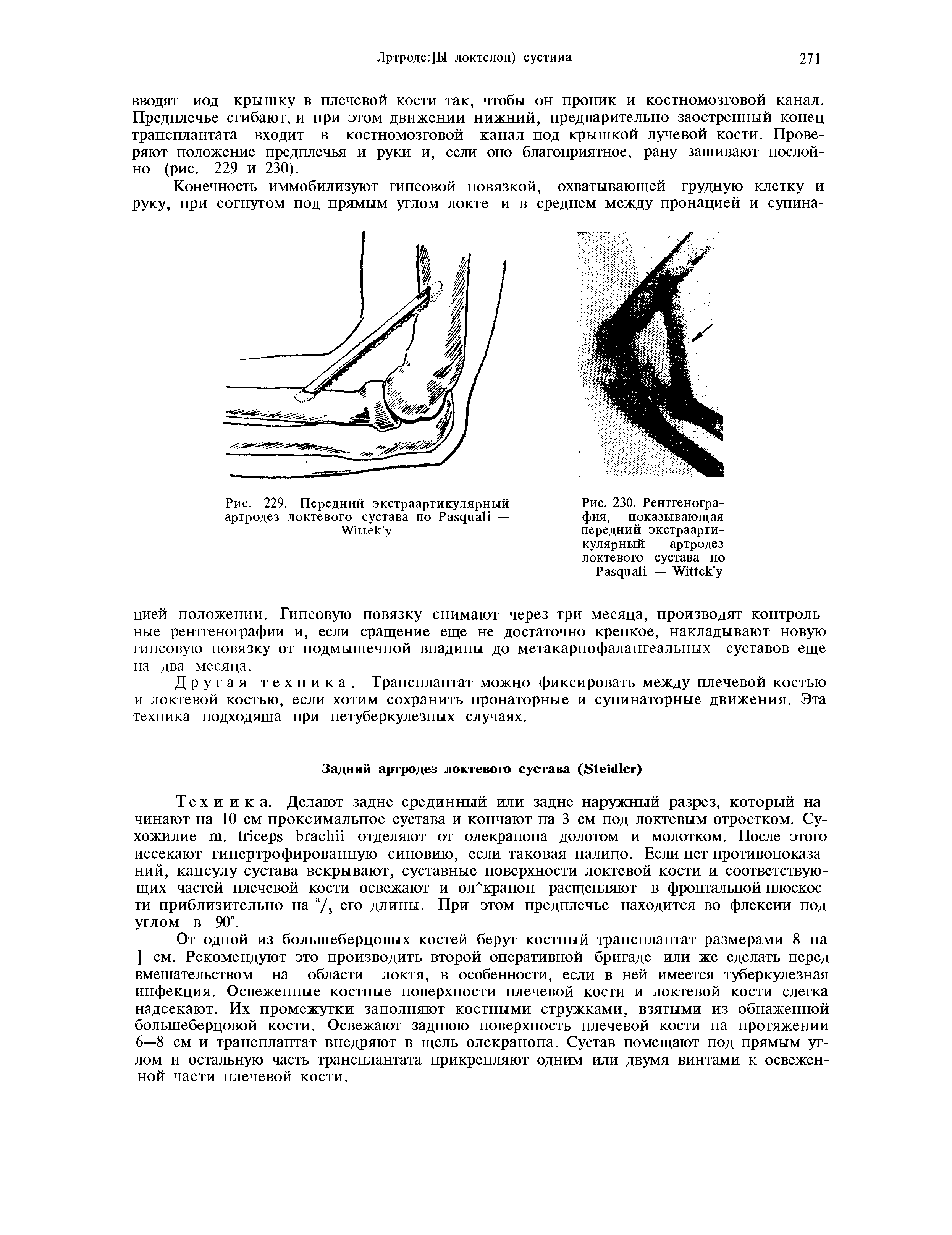 Рис. 230. Рентгенография, показывающая передний экстраартикулярный артродез локтевого сустава по...