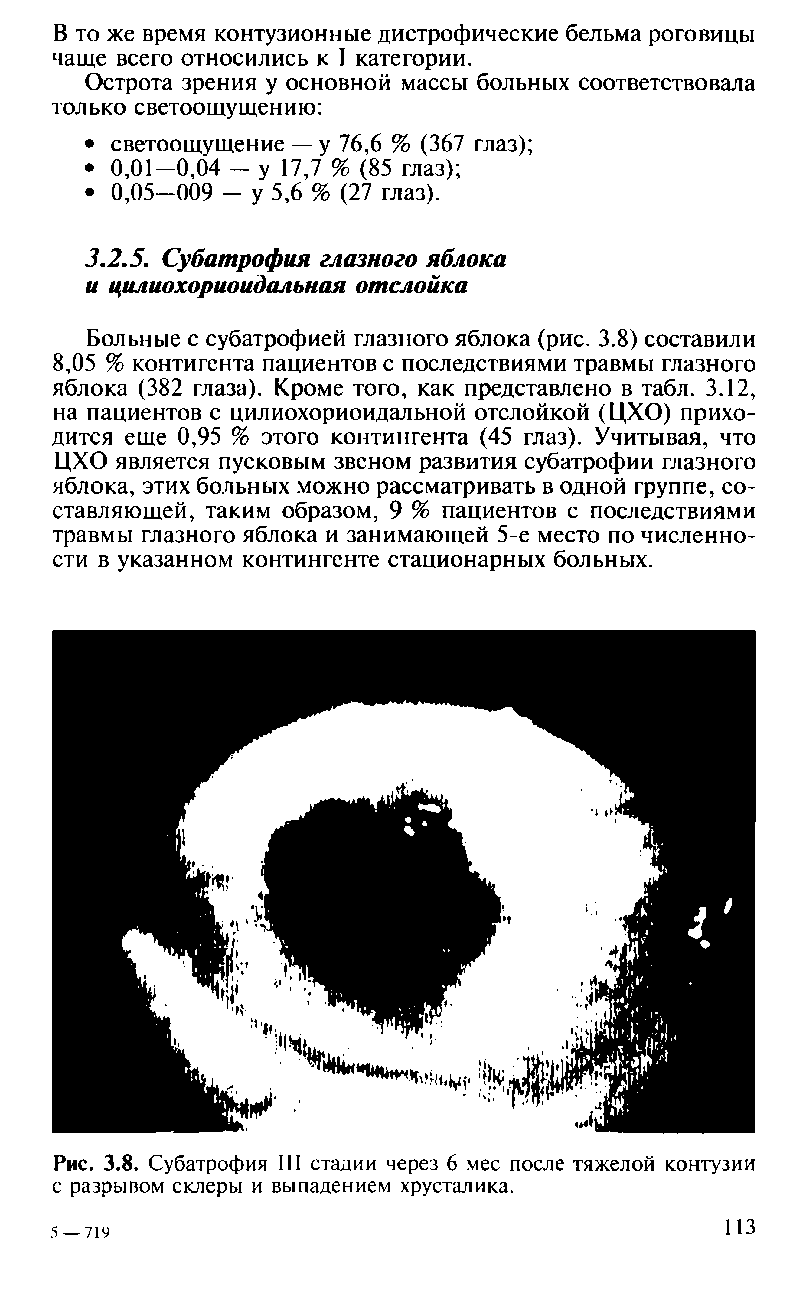 Рис. 3.8. Субатрофия III стадии через 6 мес после тяжелой контузии с разрывом склеры и выпадением хрусталика.