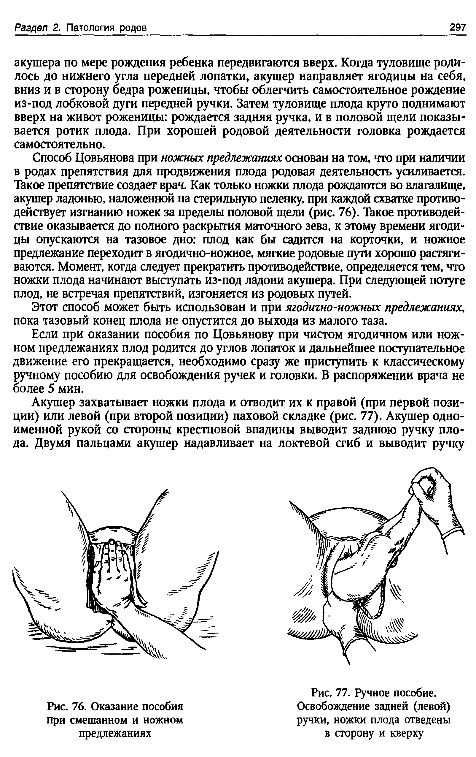 Рис. 77. Ручное пособие. Освобождение задней (левой) ручки, ножки плода отведены в сторону и кверху...