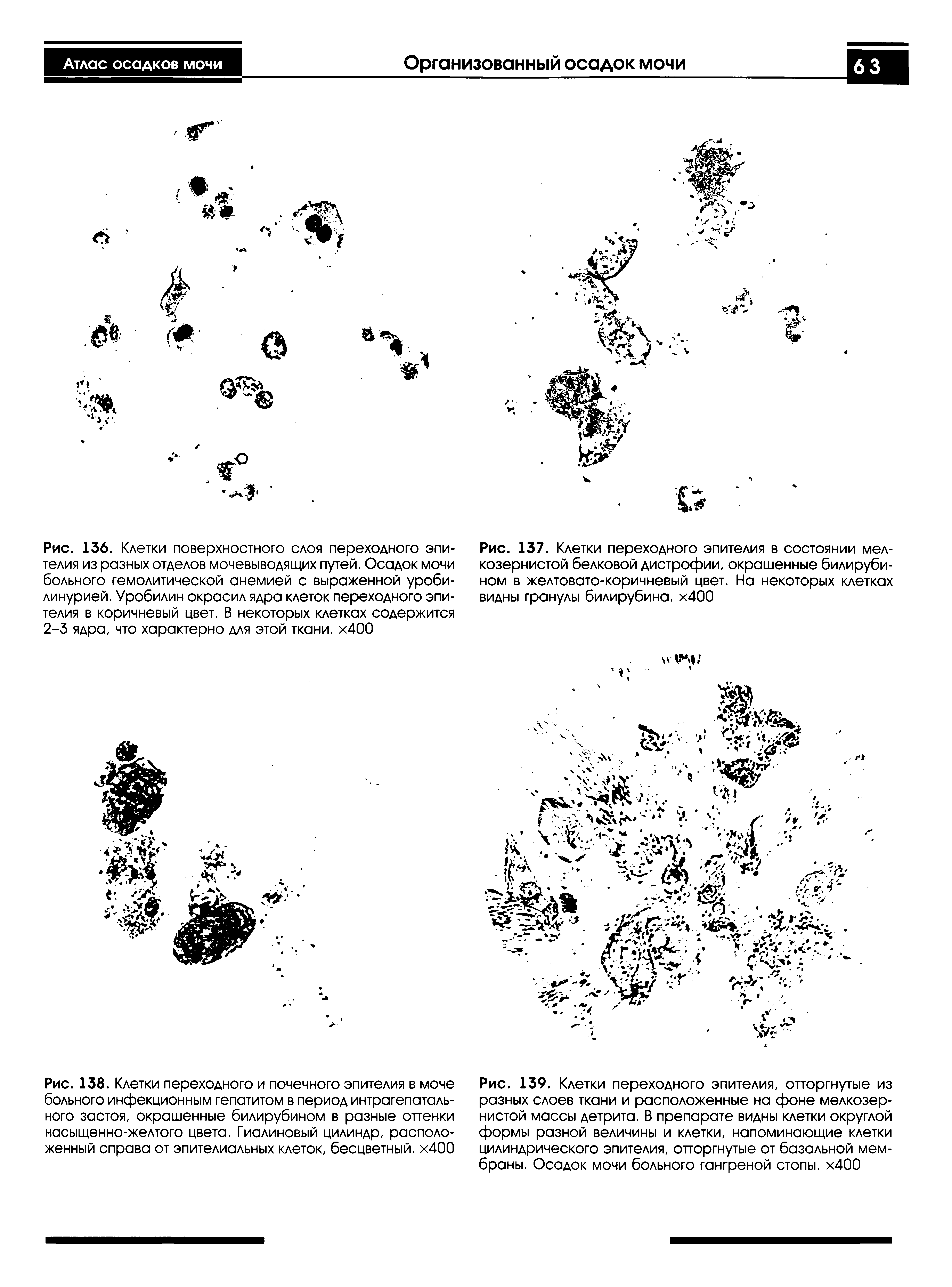 Рис. 138. Клетки переходного и почечного эпителия в моче больного инфекционным гепатитом в период интрагепаталь-ного застоя, окрашенные билирубином в разные опенки насыщенно-желтого цвета. Гиалиновый цилиндр, расположенный справа от эпителиальных клеток, бесцветный. х400...